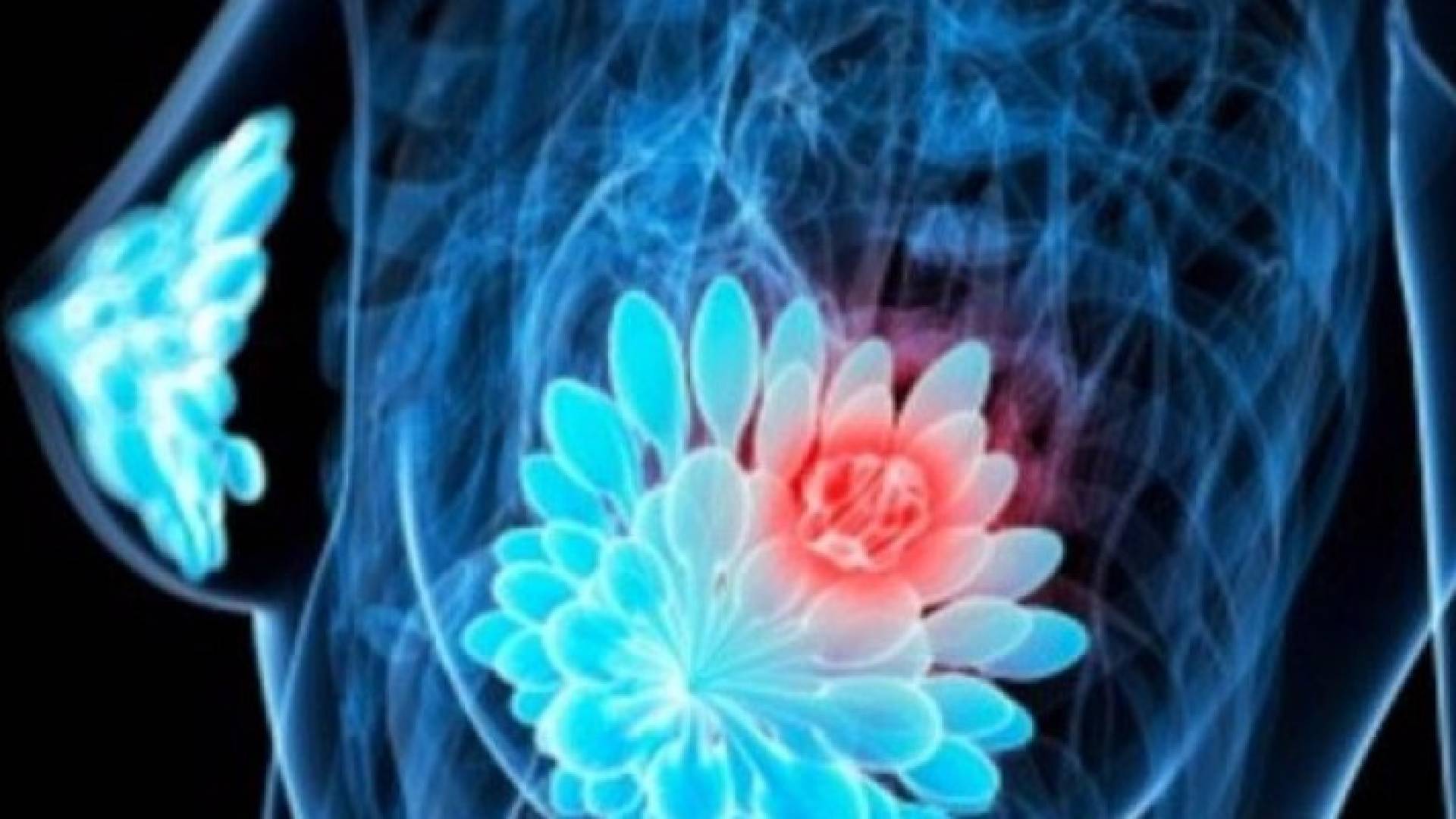 اتباع الأنظمة الغذائية ذات السعرات الحرارية المنخفضة يمكن أن يحمي الناس من الإصابة بسرطان الثدي