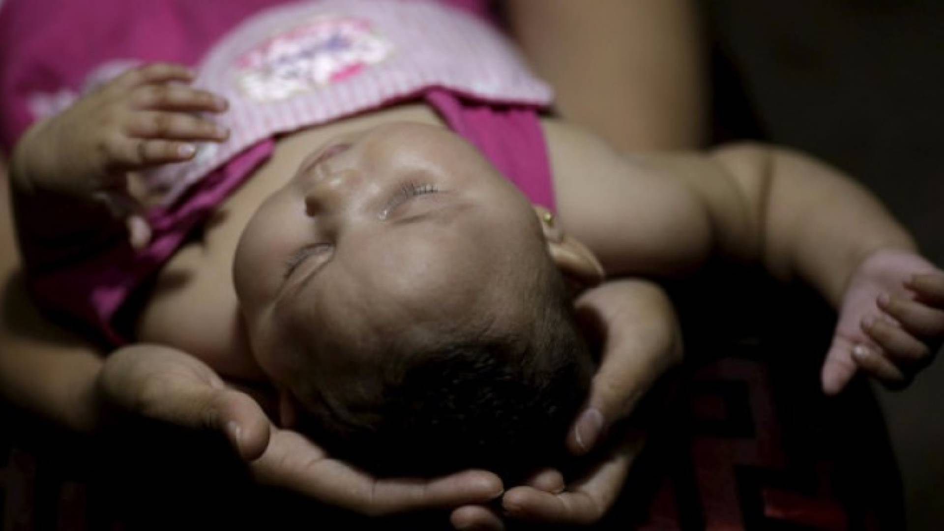 فلوريدا.. أول مولود بعيوب خلقية بسبب زيكا