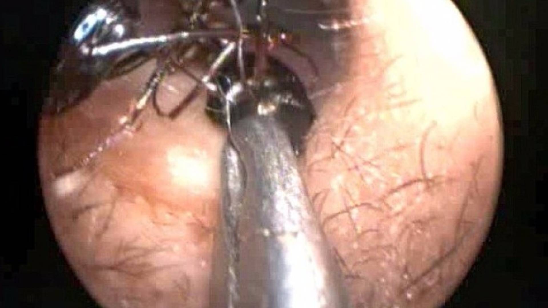 الأطباء يعجزون عن حل لغز استيطان ألف نملة في أذن طفلة هندية .. فيديو