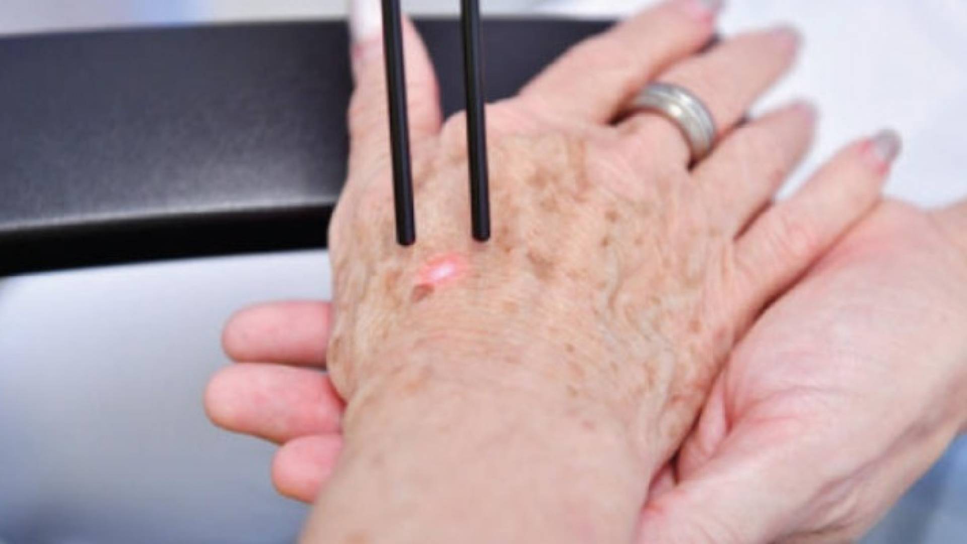 بقع الشيخوخة.. أسباب وحلول