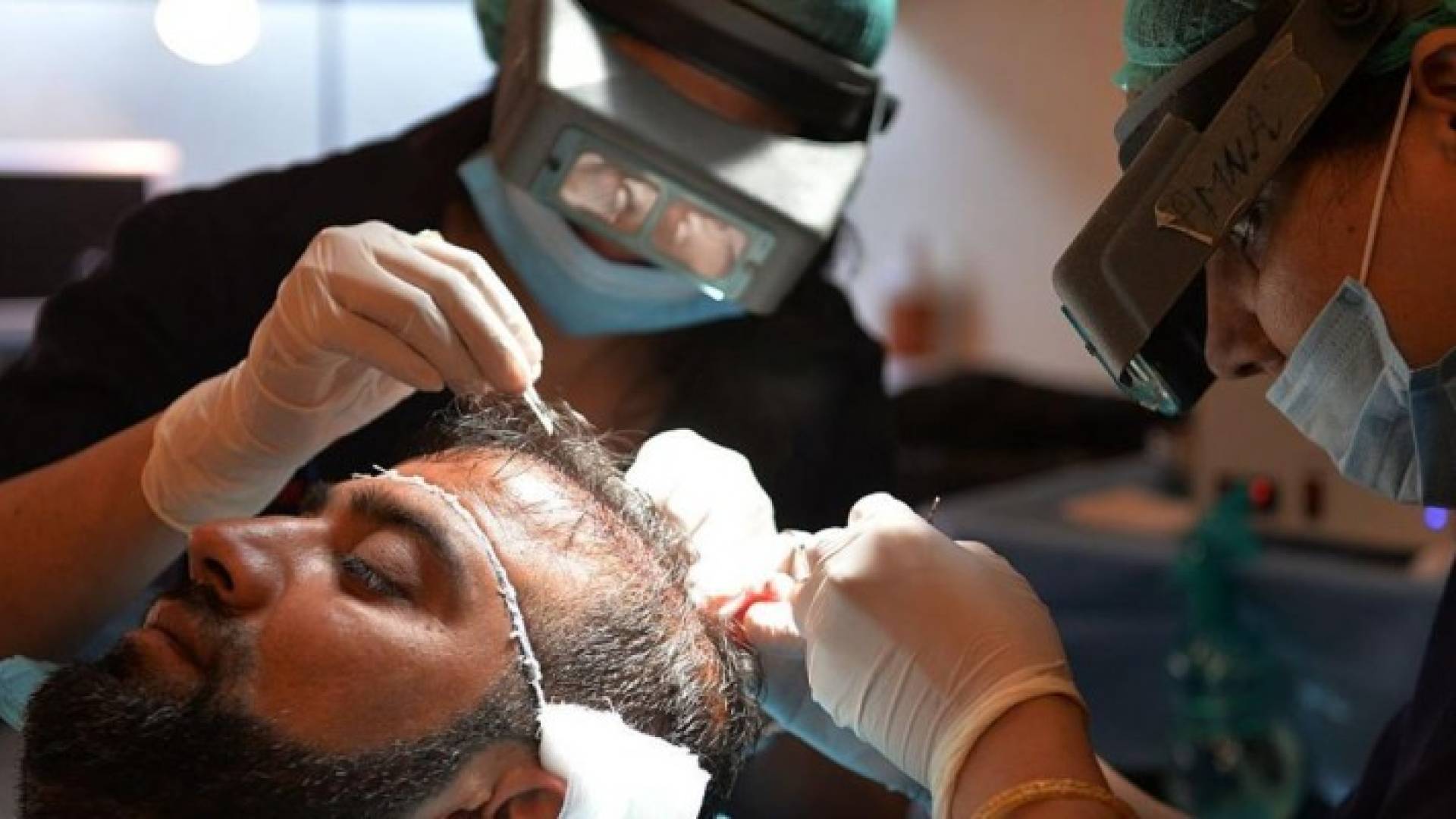 دراسة توضح "تأثير" زرع الشعر عند الرجال