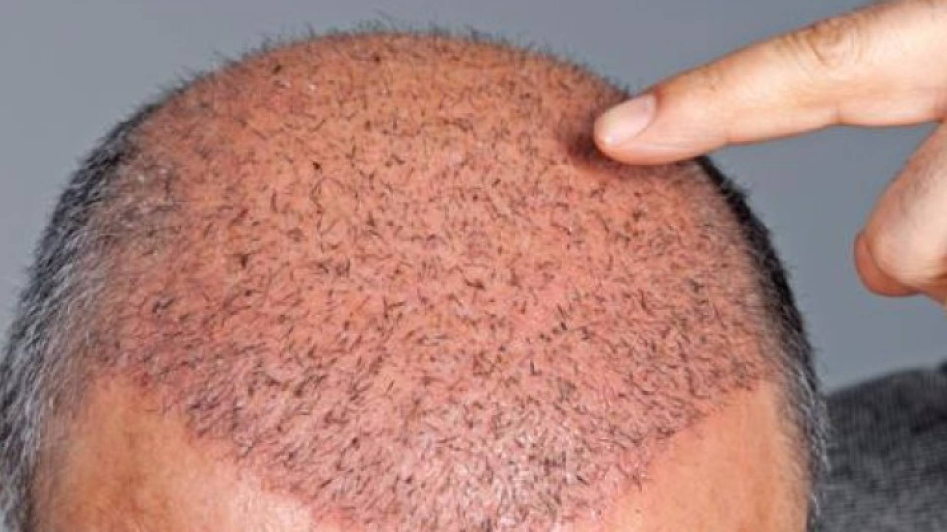 دراسة توضح تأثير زرع الشعر عند الرجال