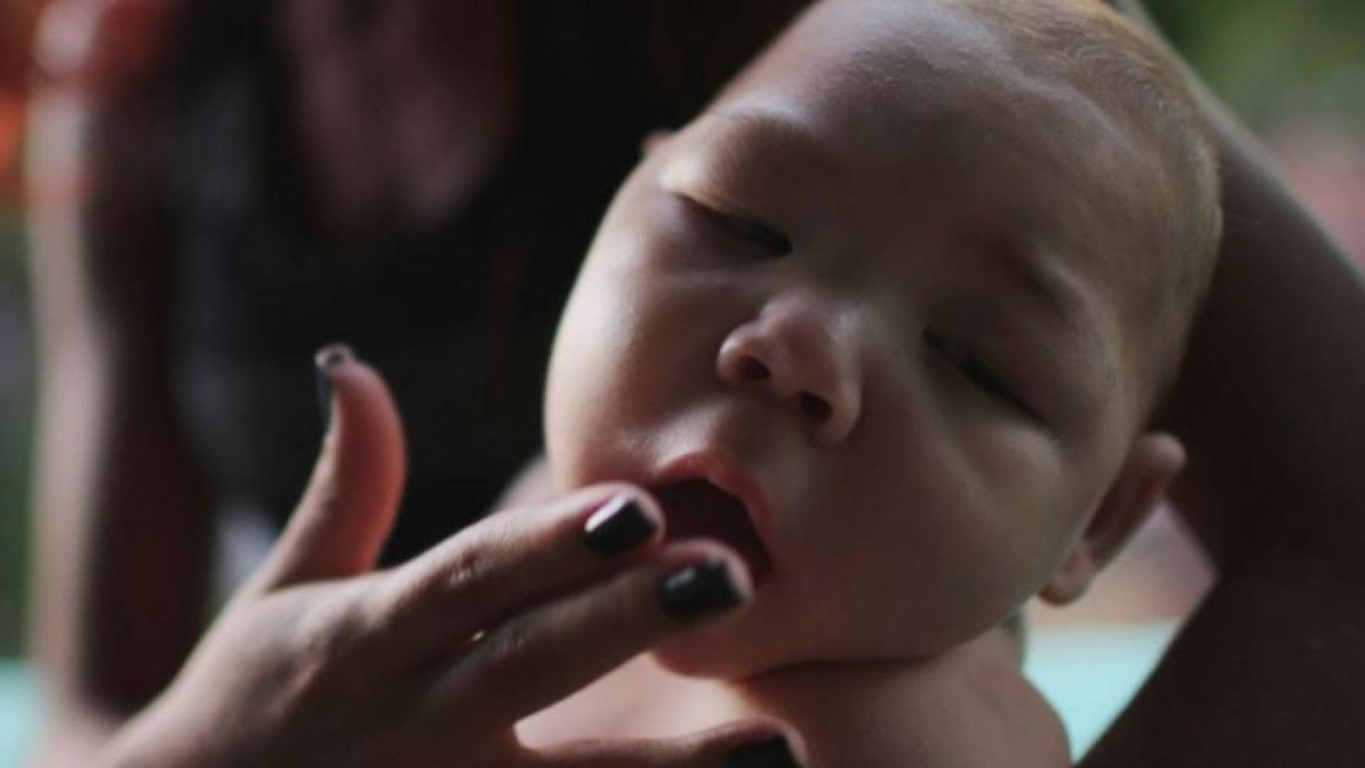 زيكا يسبب حالات فقدان للسمع