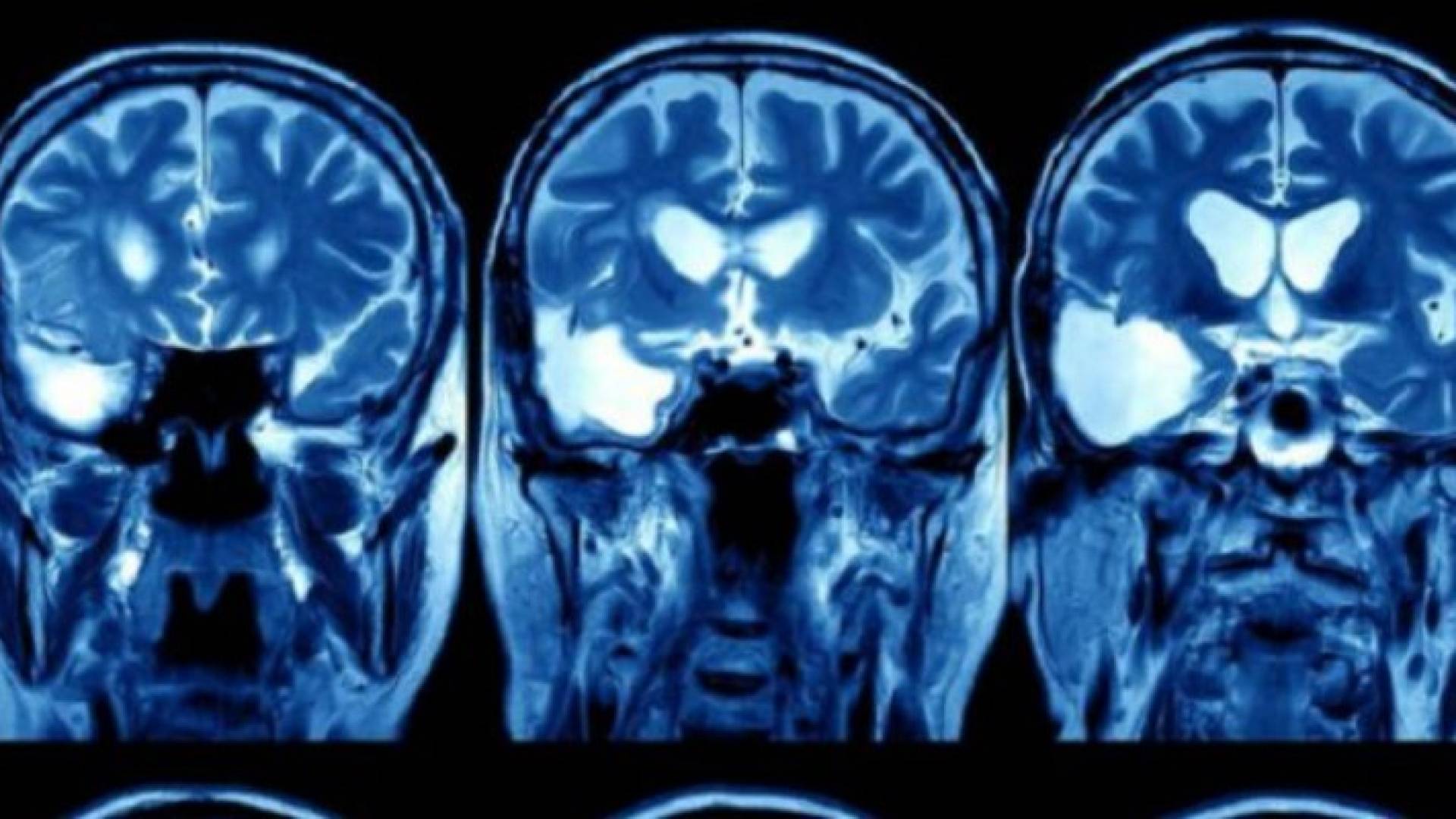 استخدام نظام الذكاء الصناعي لغوغل في علاج سرطان الرأس والعنق