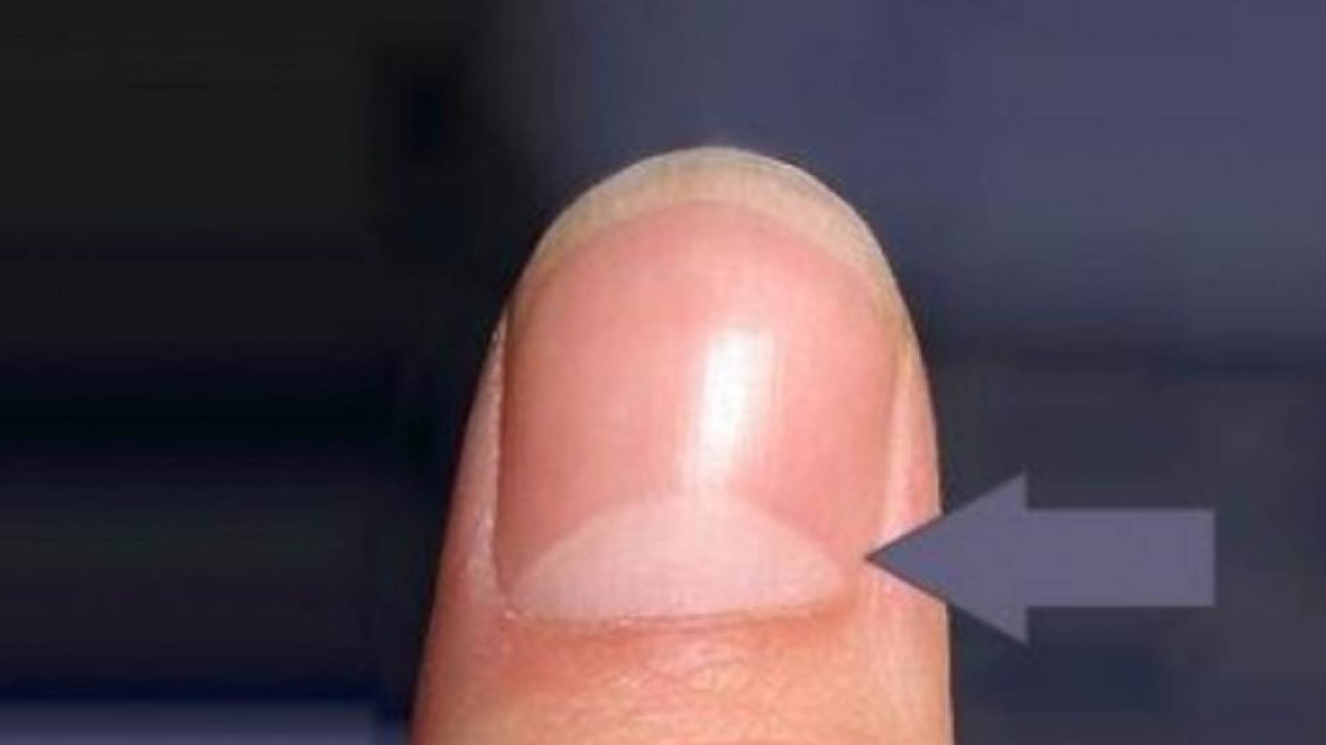 ماذا يعني هذا الهلال الأبيض على الأظافر؟