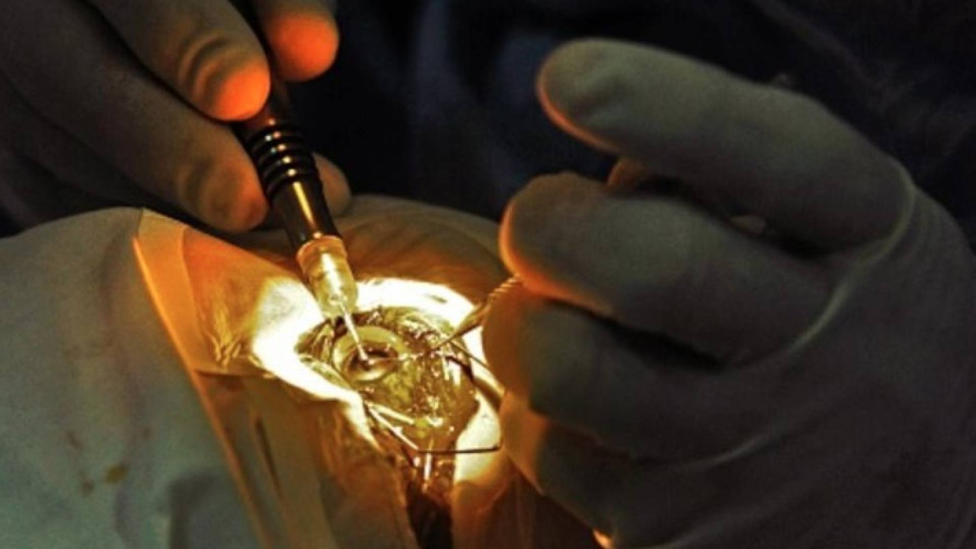 أول عملية جراحية ناجحة داخل العين باستخدام روبوت
