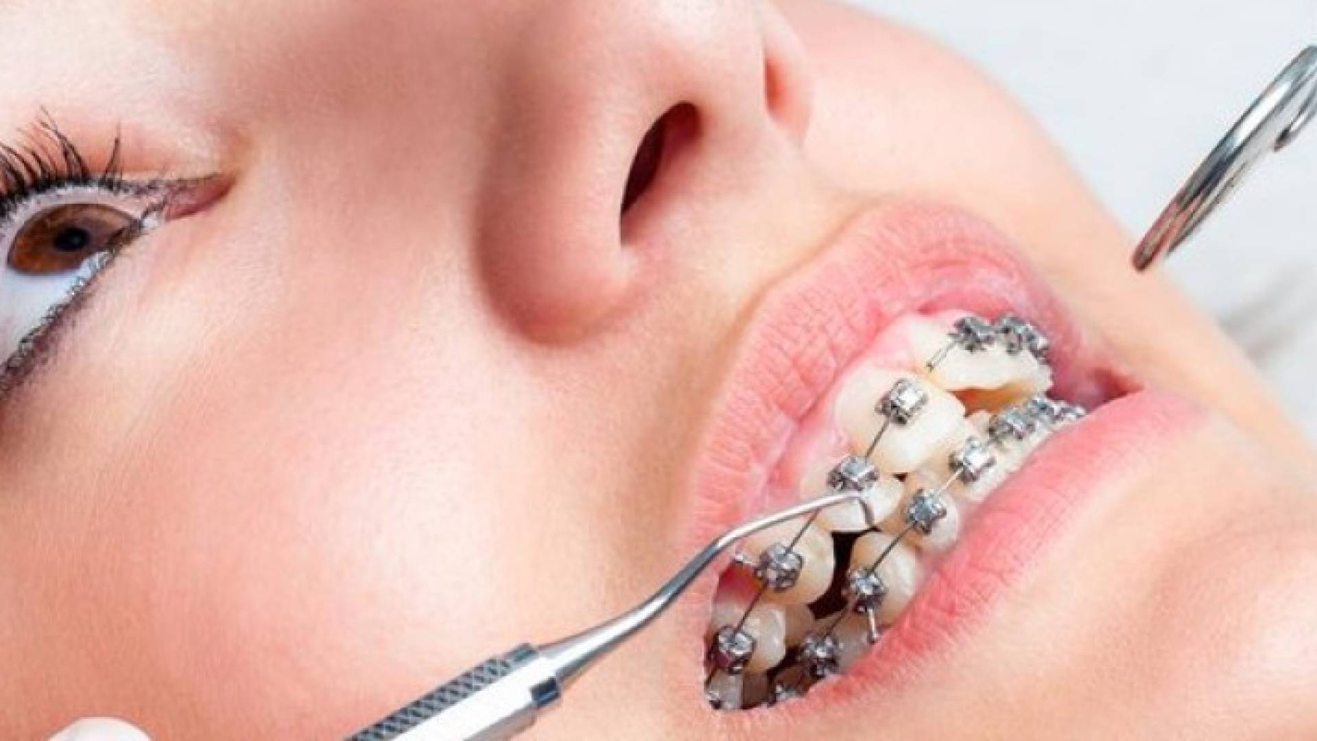 إلى مرضى تقويم الأسنان.. تجنبوا هذه الأطعمة والعادات!