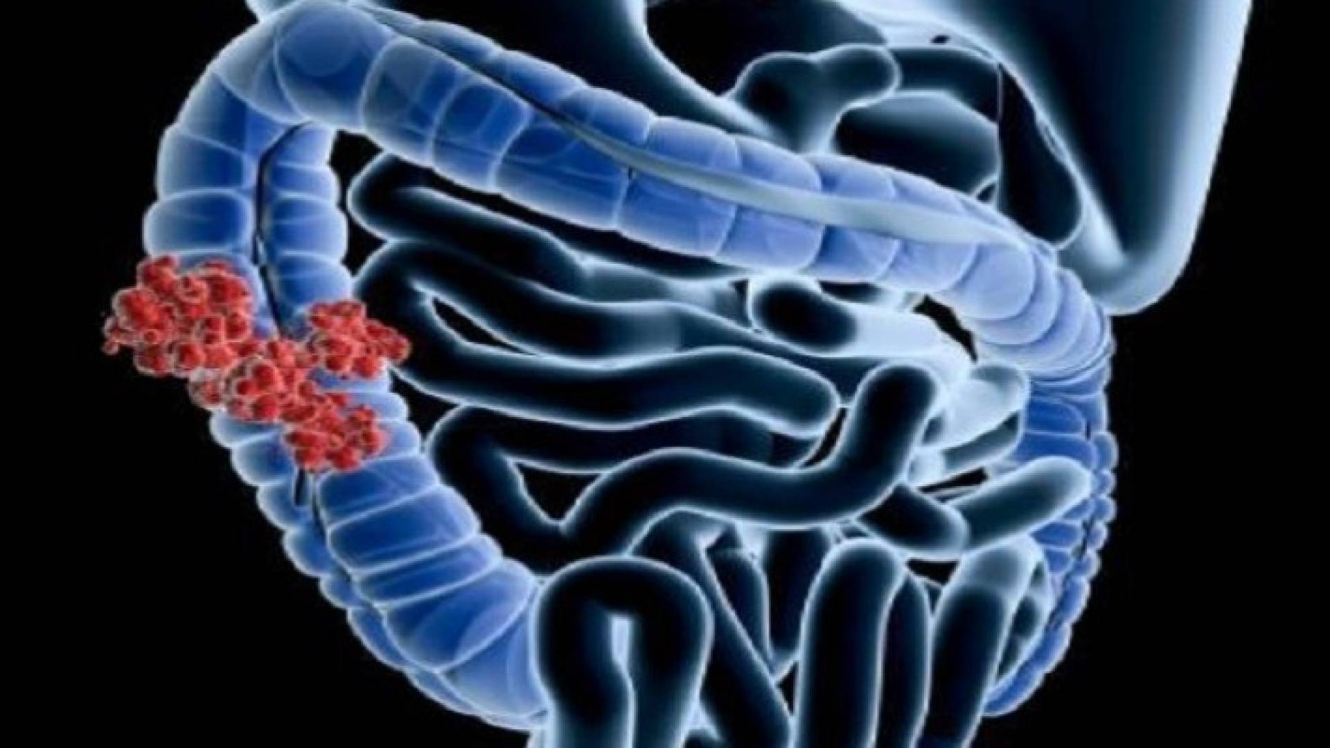 سرطان الأمعاء الغليظة