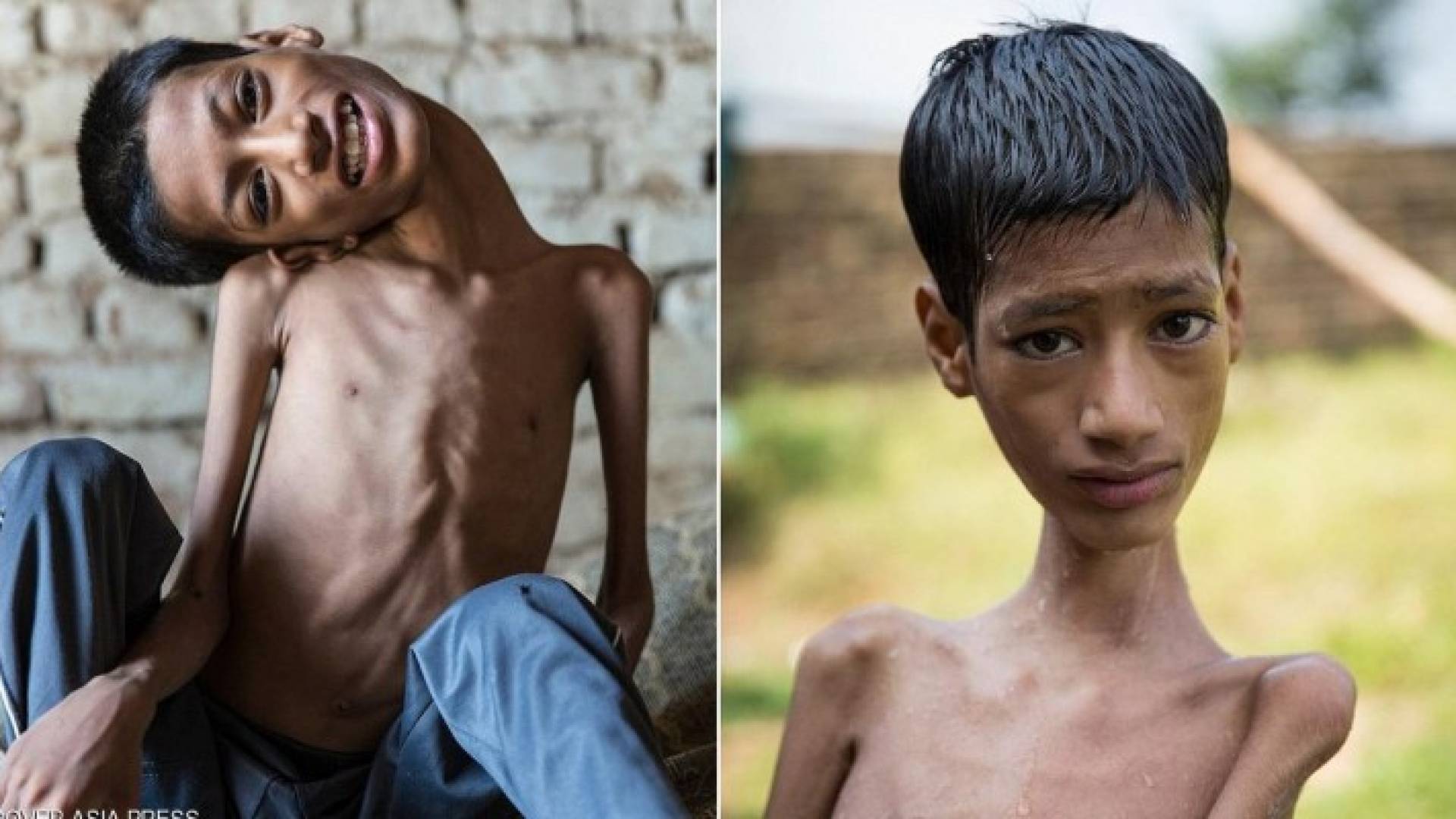 الطفل كان عاجزا عن ممارسة حياته الطبيعية