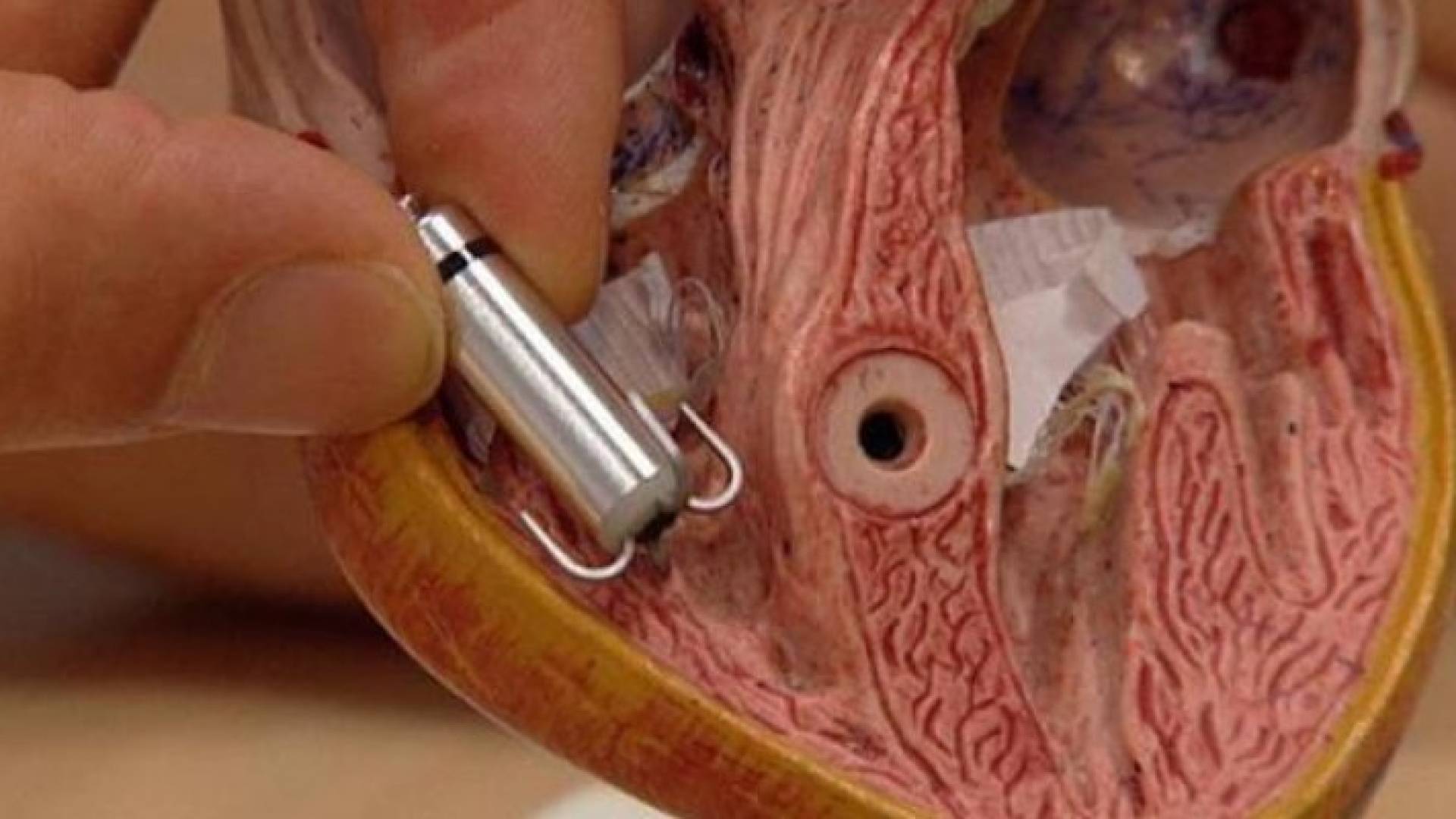 خلل في بطارية أجهزة للقلب قد تؤدي للوفاة