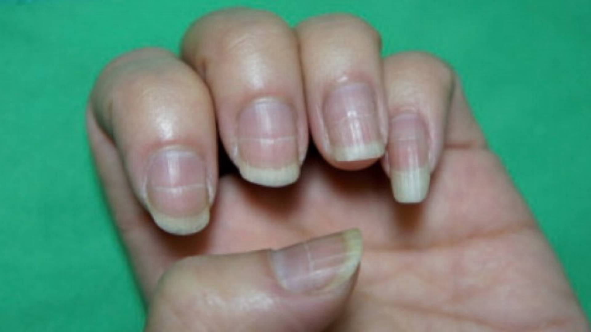 8 أمراض تخبرك بها أظافرك.. سرطان الجلد أحدها