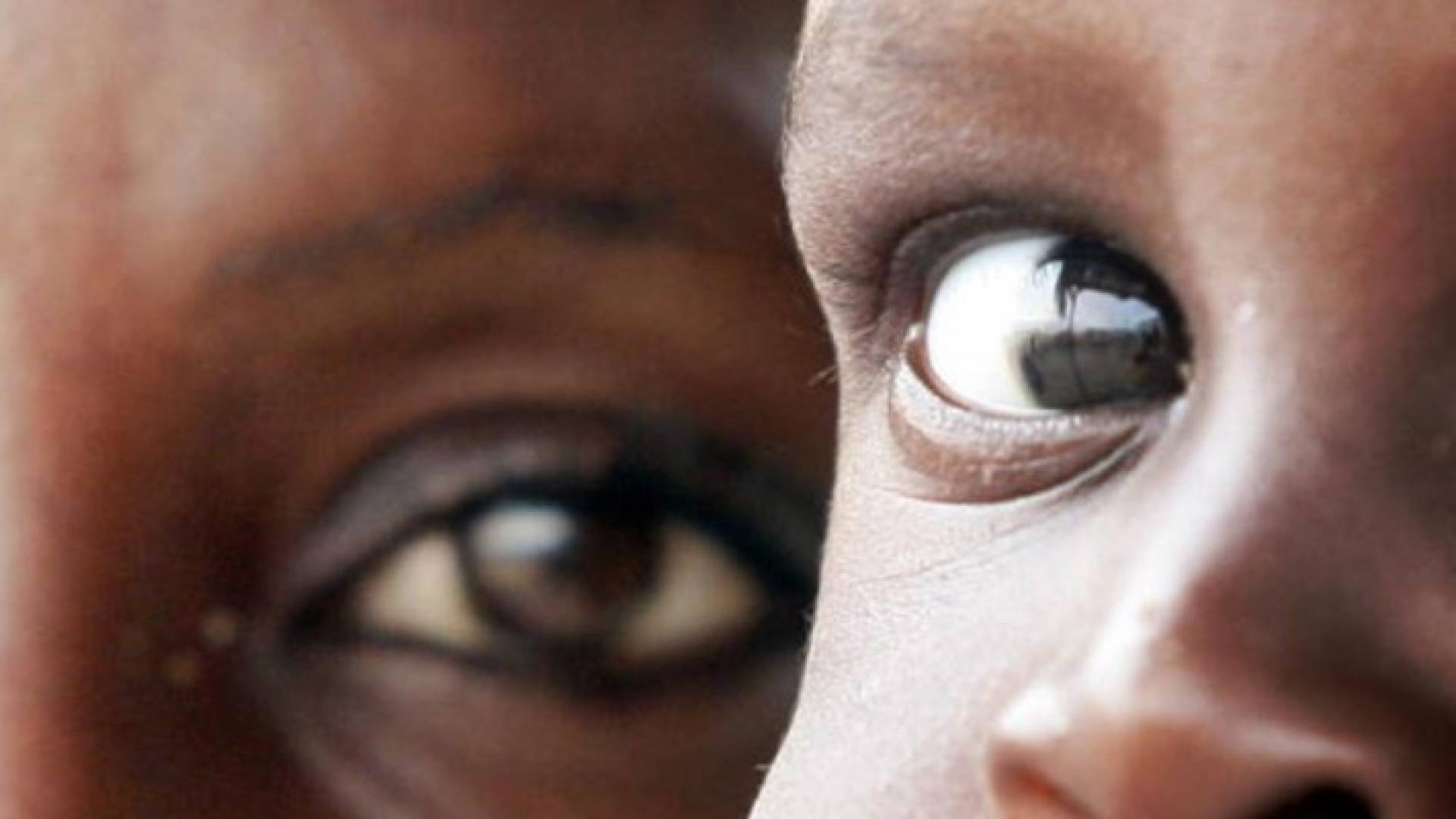  الهزال والتقزم يهدد نسبة كبيرة من أطفال السودان بسبب سوء التغذية (أرشيف)