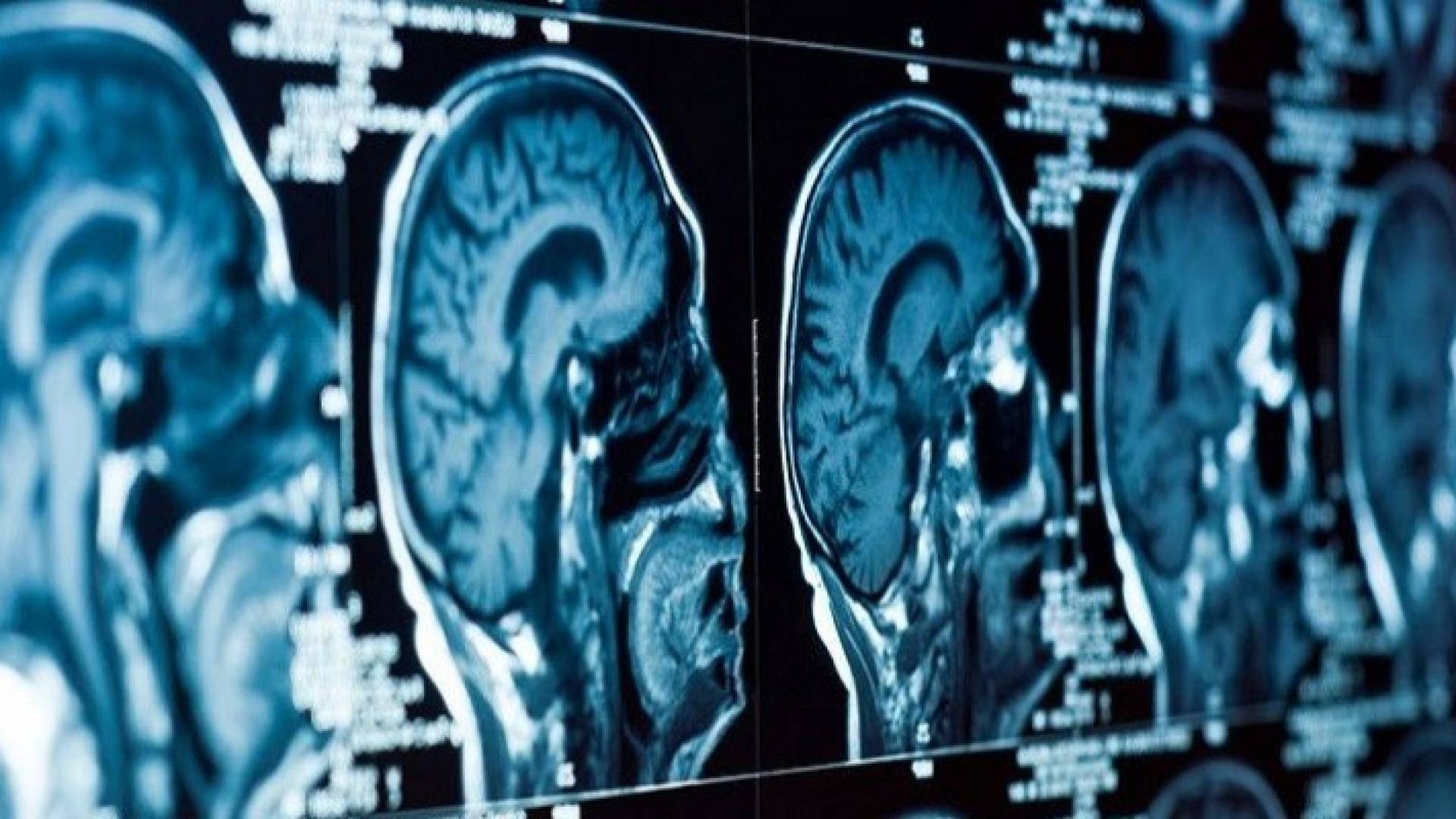 العلماء يحددون مصدر الاكتئاب في الدماغ