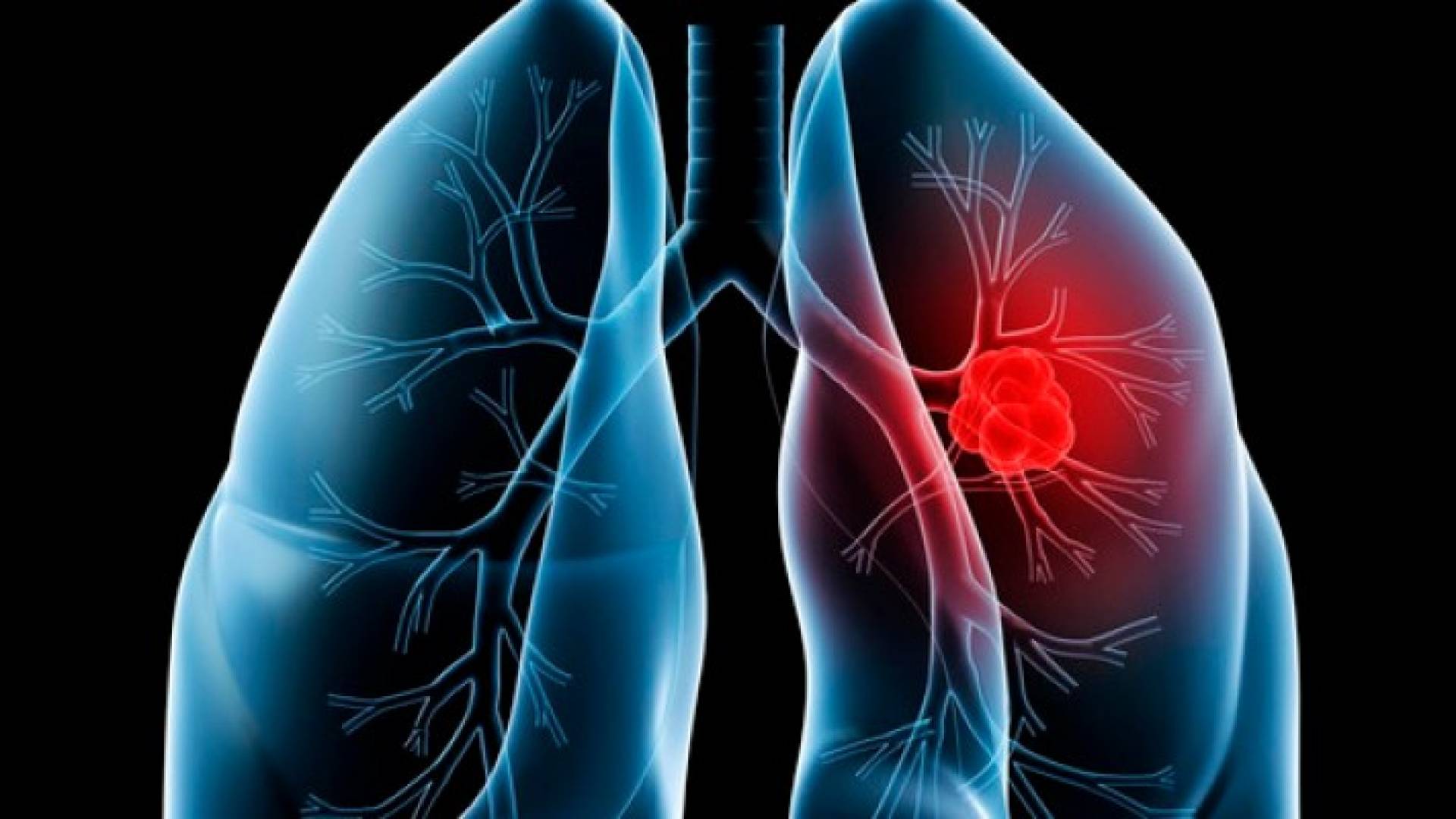 سرطان الرئة