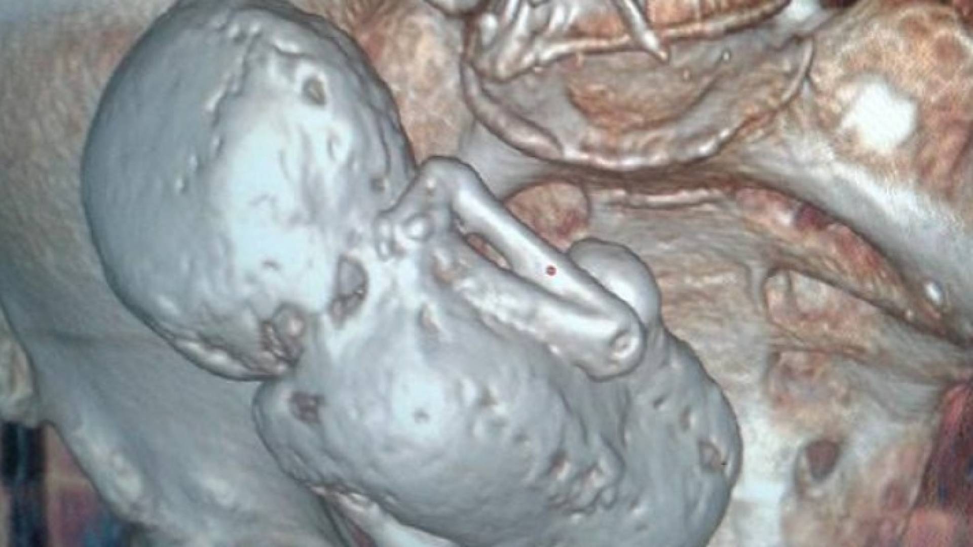 الجنين تحجر في بطن السيدة العجوز