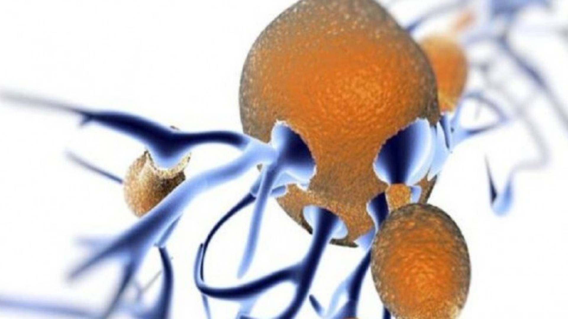 علاج بالموجات يظهر نتائج واعدة بعلاج سرطان البروستات