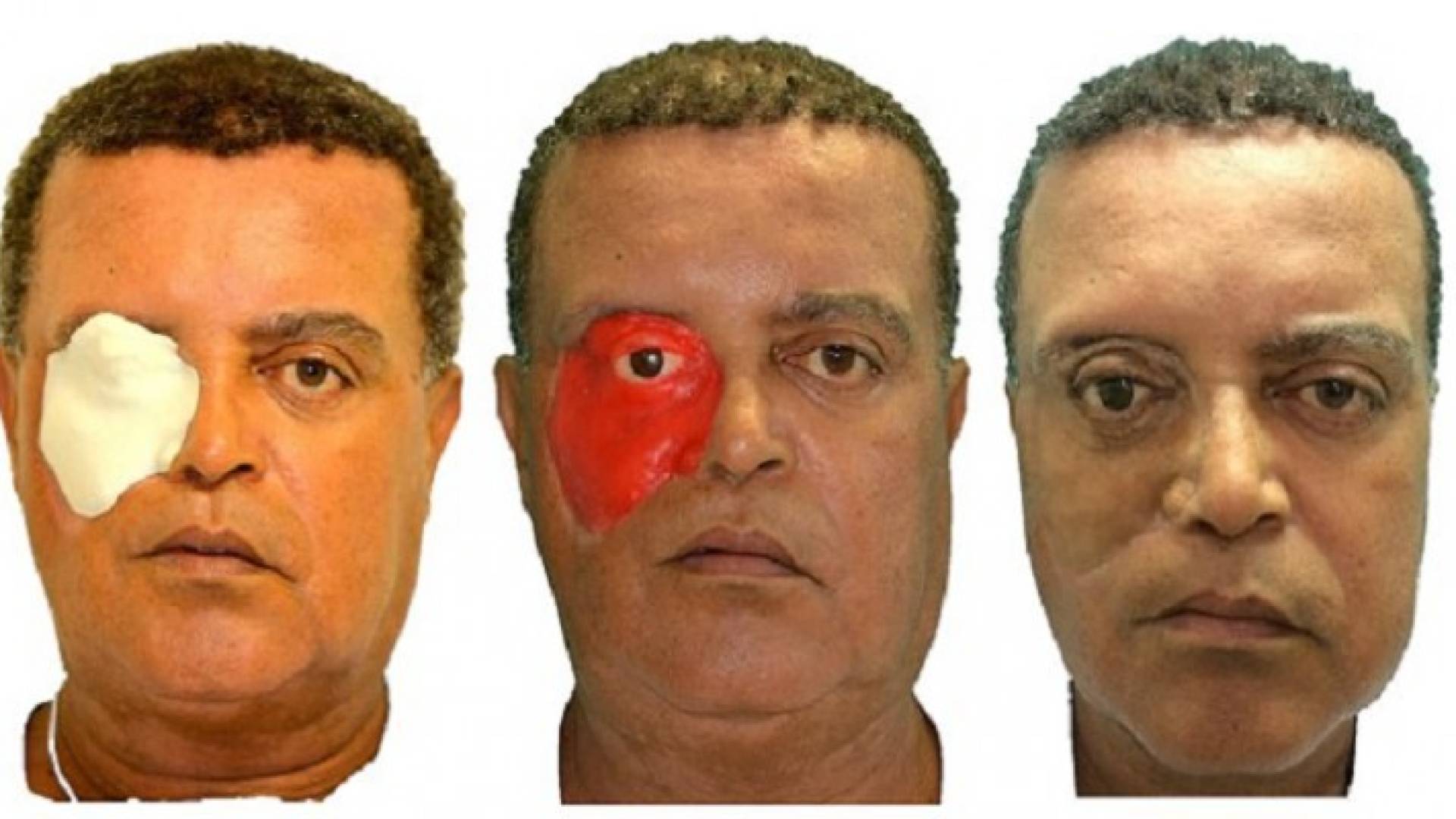  أول شخص في العالم يحصل على وجه مطبوع بتقنية 3D