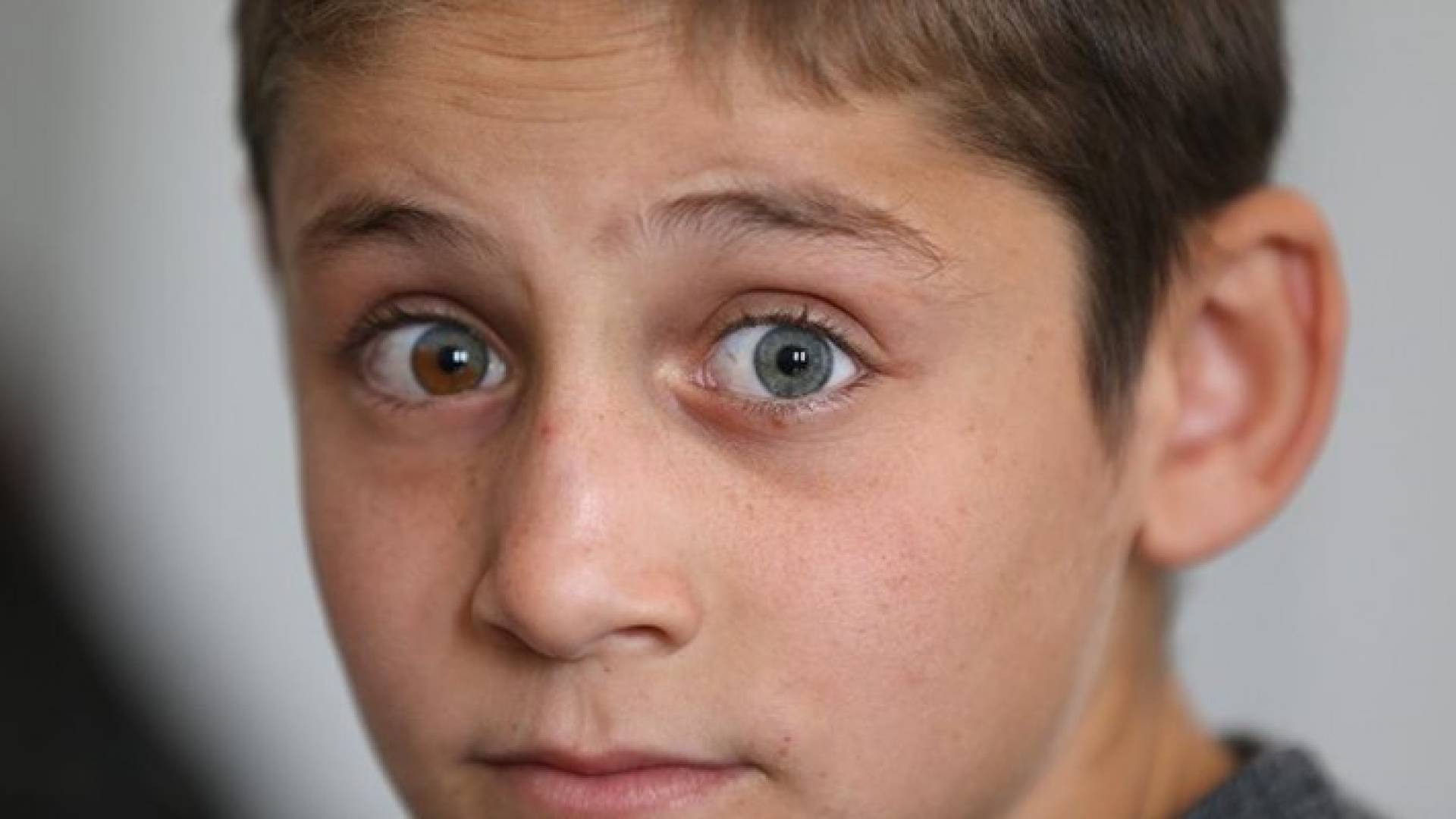 الطفل إحدى عينيه ذات لون أرزق والأخرى نصفها أزرق ونصفها بني