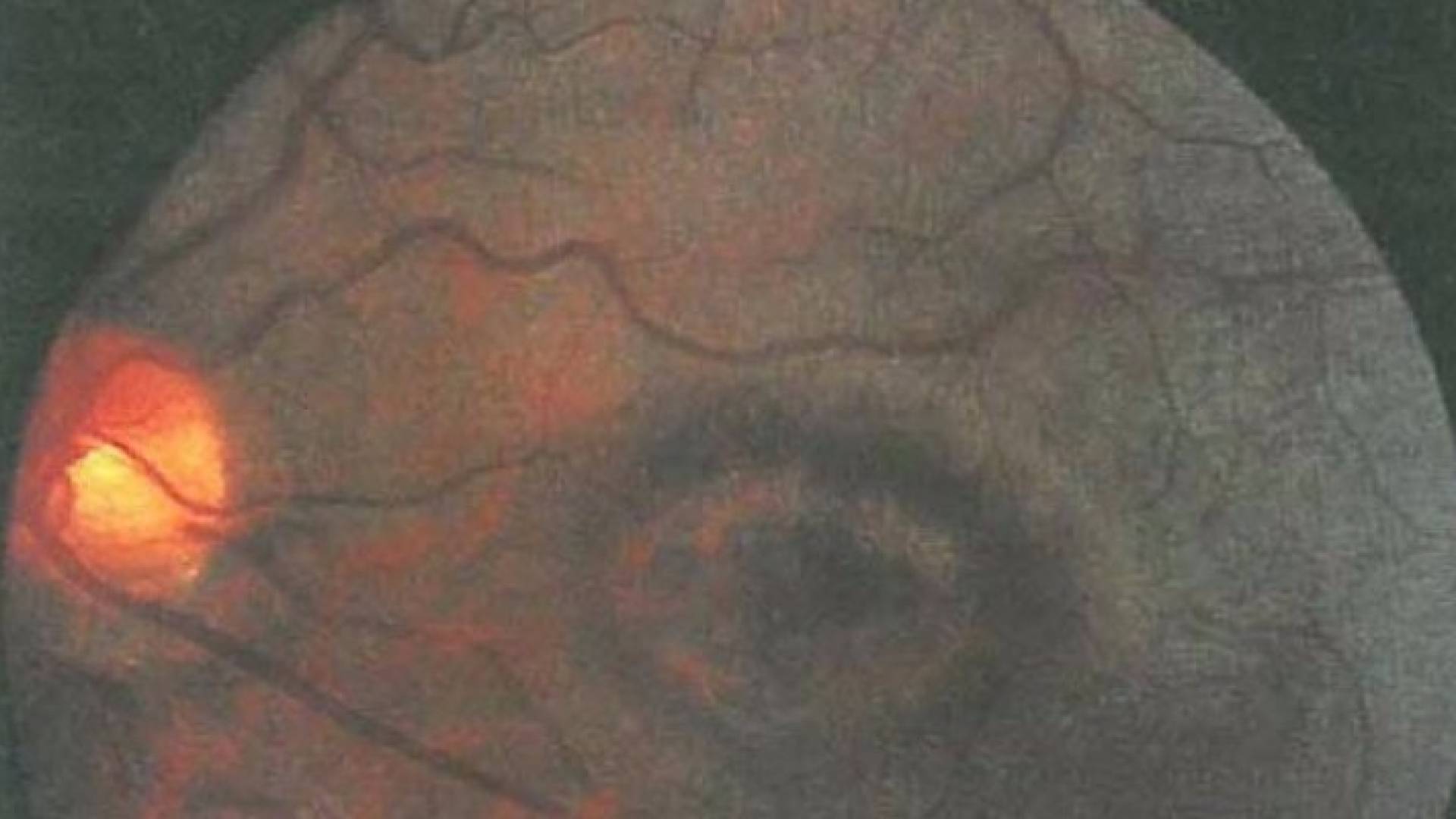 صورة مجهرية لمرض حساسية العين إزاء سطوع الضوء