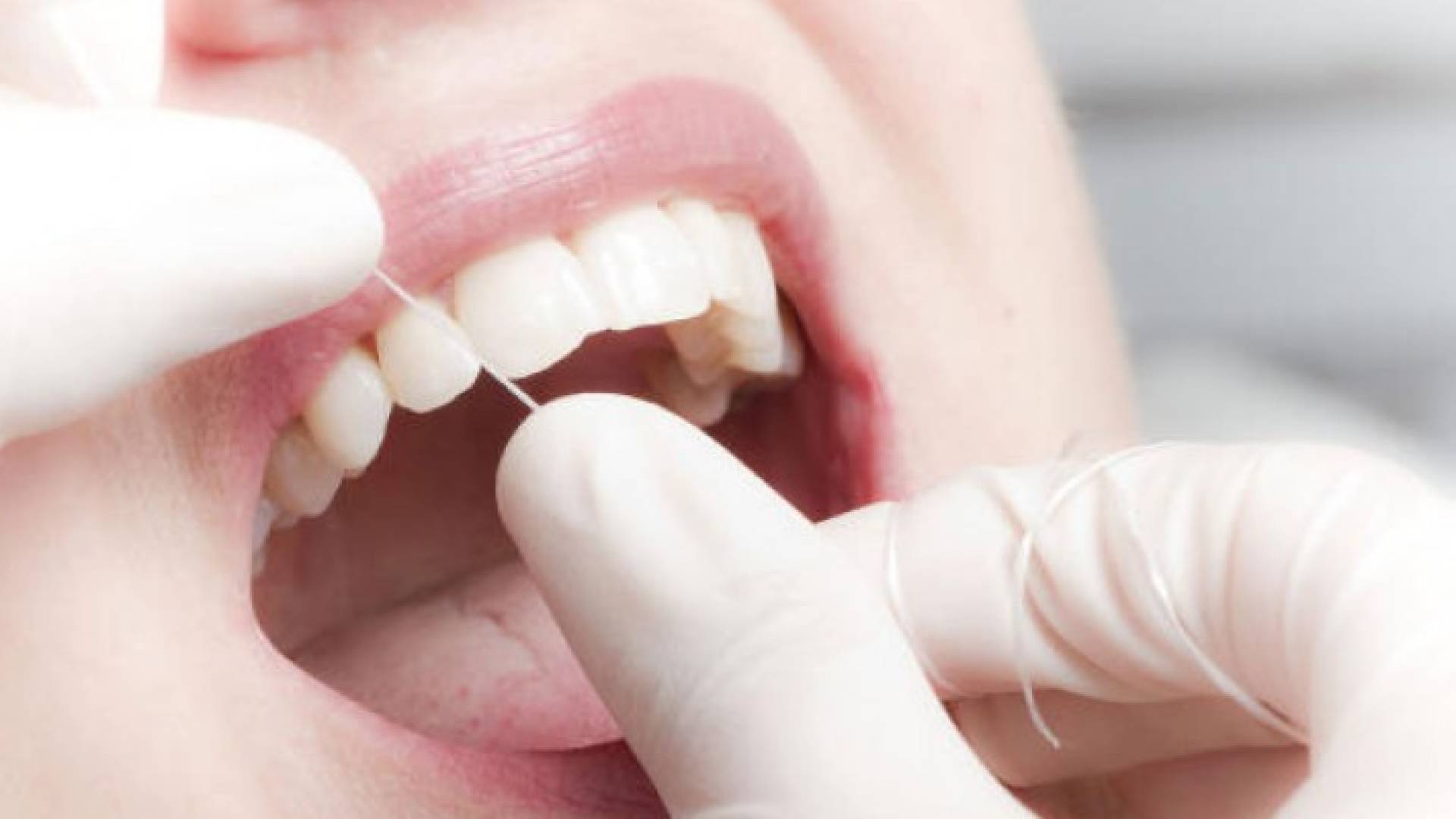 من الأفضل استخدام خيط تنظيف الأسنان كل يومين على الأقل