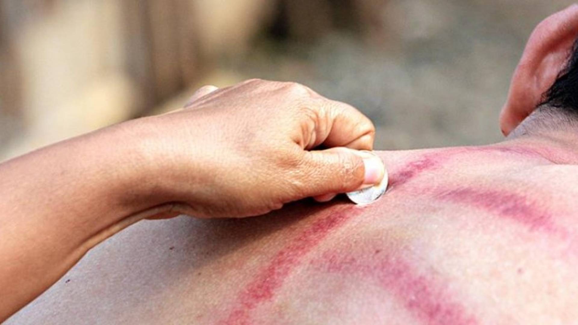 النقود المعدنية لعلاج نزلات البرد في إندونيسيا 