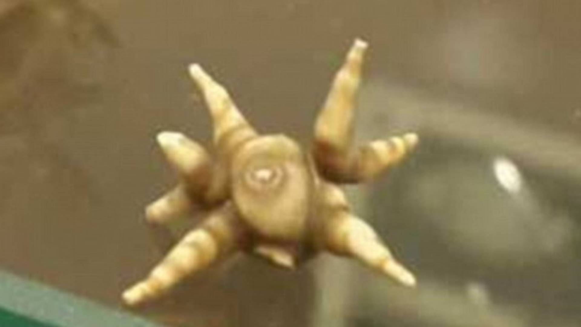 الحصوة التي تطلبت عملية جراحية من أجل إخراجها