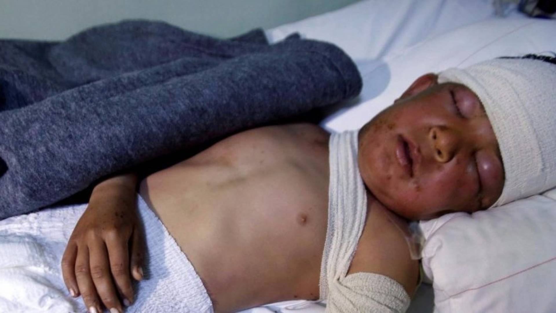 يعتقد أن عائلة تعرضت لهجمات بالكيماوي شرقي الموصل