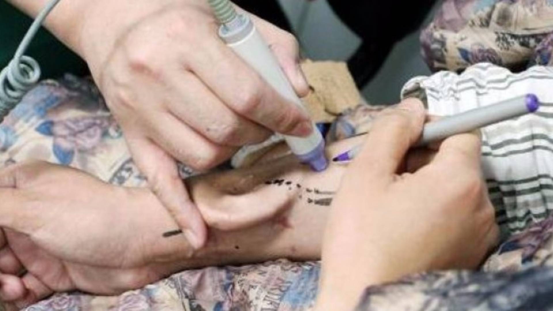 نمو أذن على يد رجل في الصين