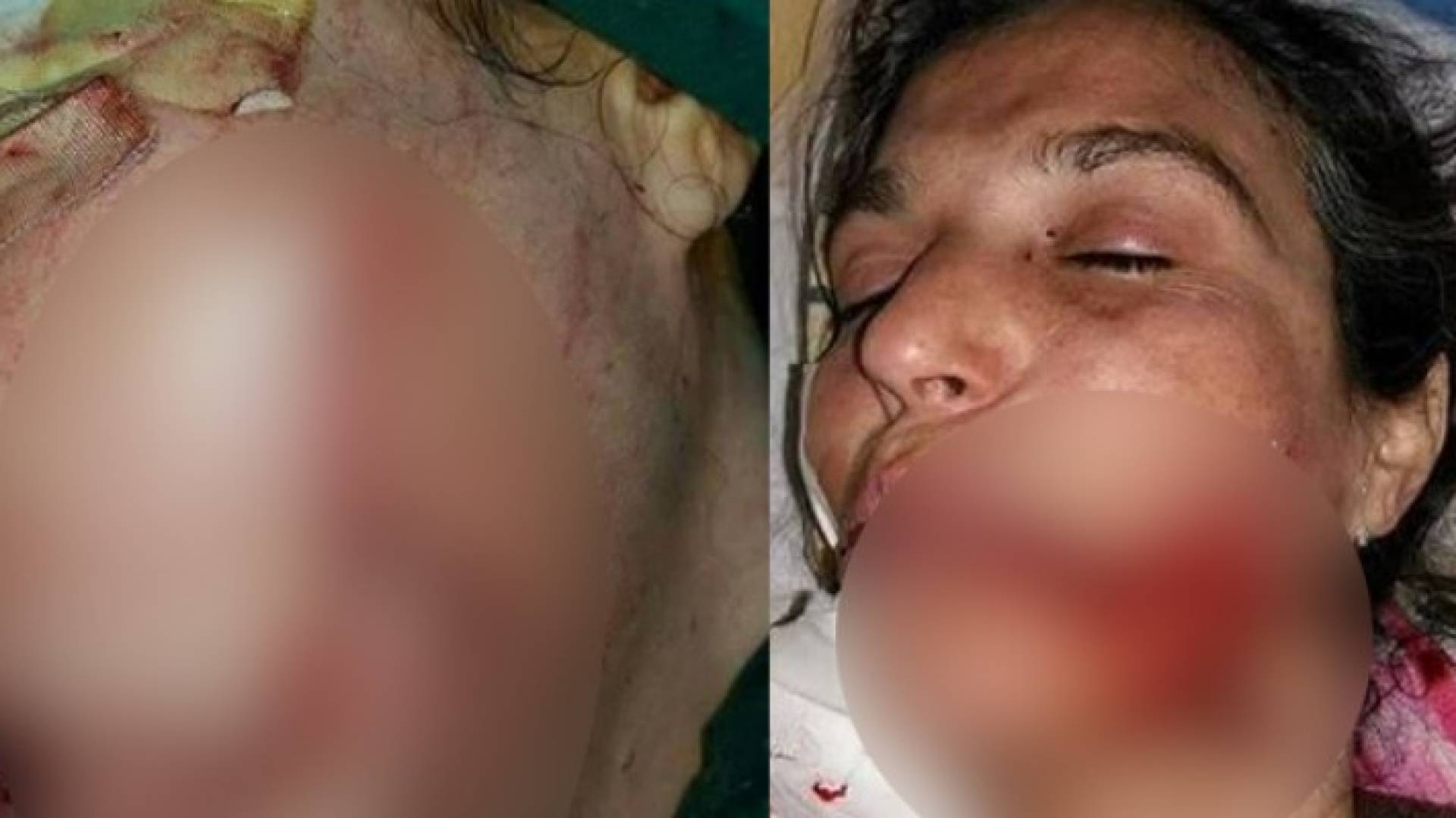 تشاجرت مع جارها الجزار فشق وجهها بالساطور