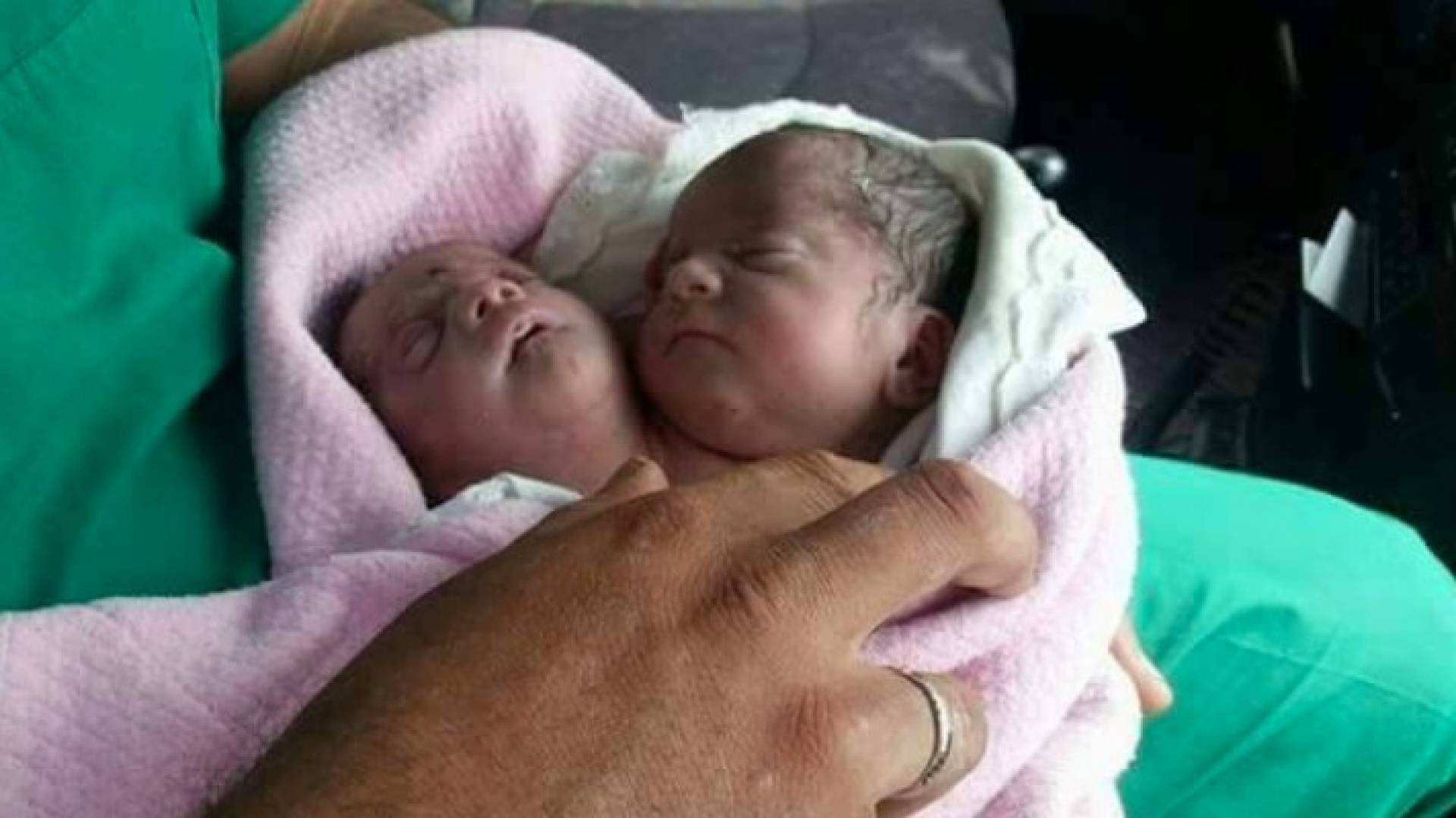 طفلة برأسين في ادلب