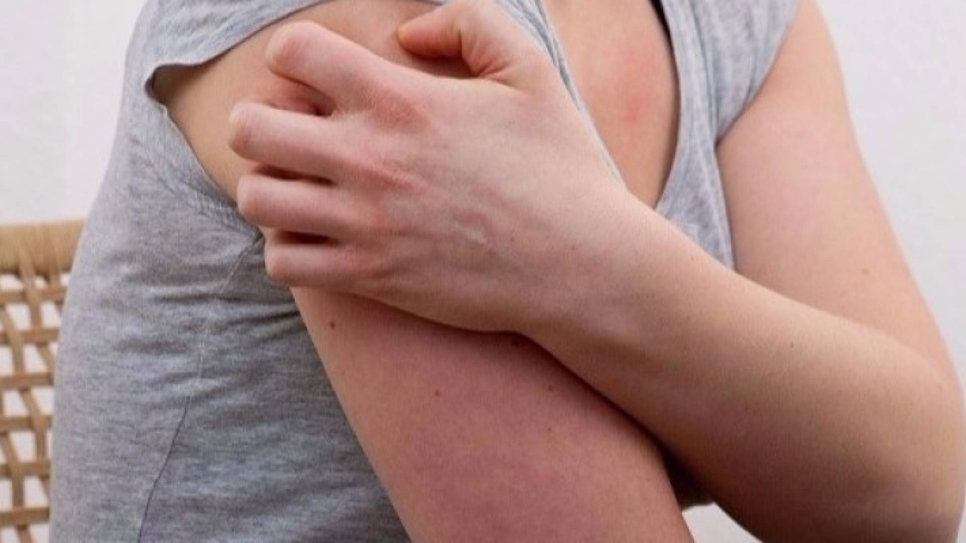 التهاب الجلد العصبي