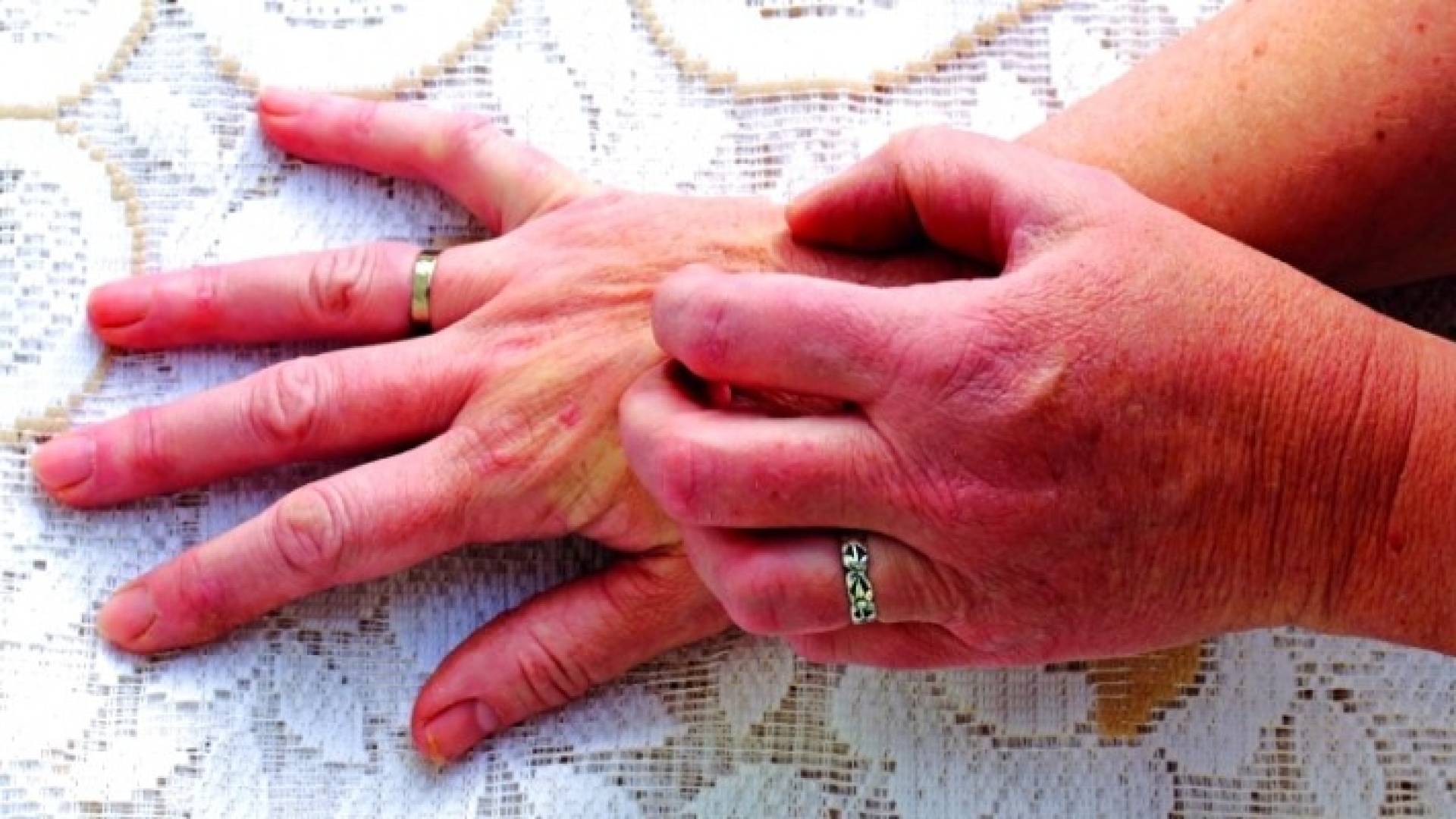 مرض الصدفية يمكن أن يكون له تأثير نفسي كبير