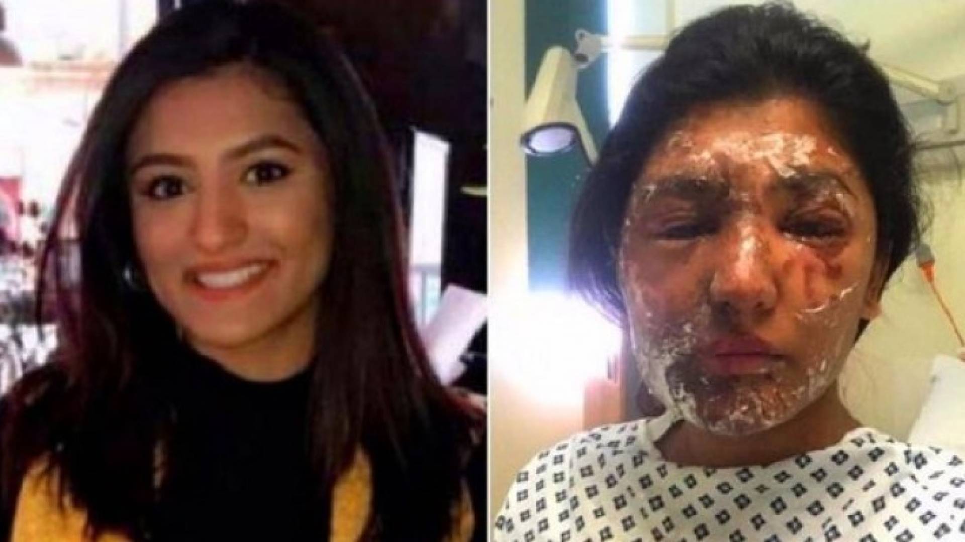 هجمة بأسيد الكبريت على وجه باكستانية وقريبها بلندن