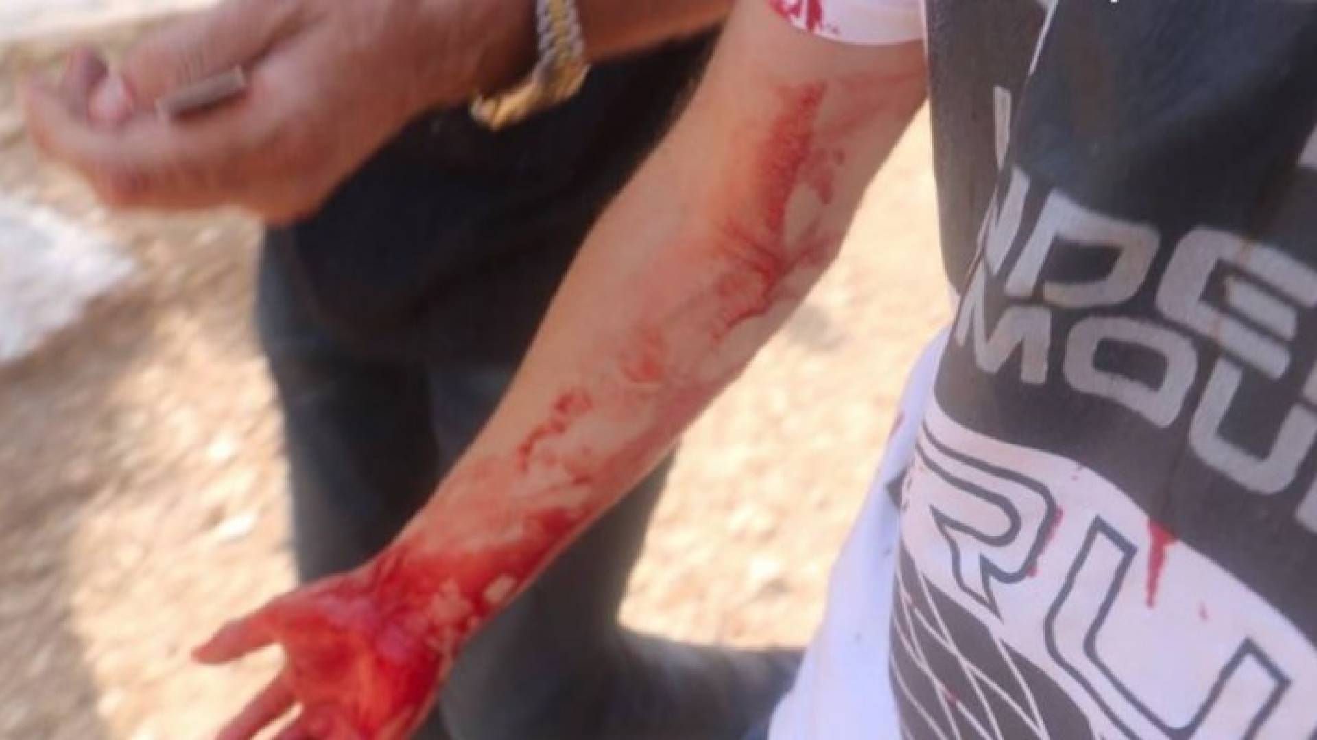 إحدى الاصابات باقتحام قوات الاحتلال للحرم القدسي