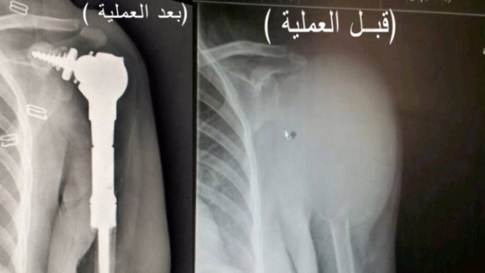 نتائج متميزة لعملية زراعة مفصل الكتف في الخدمات الطبية الملكية