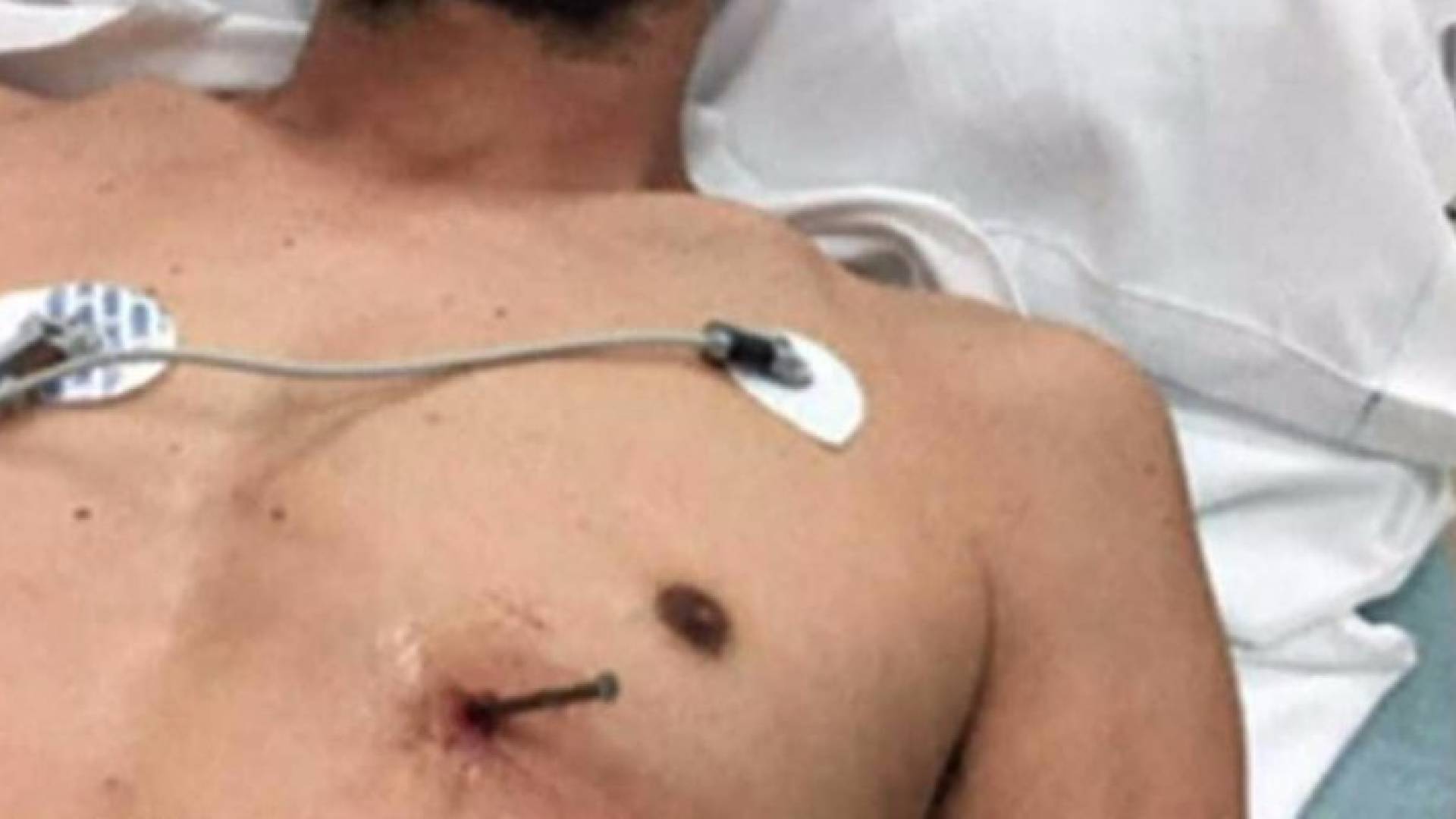 المسمار استقر في قلب الرجل