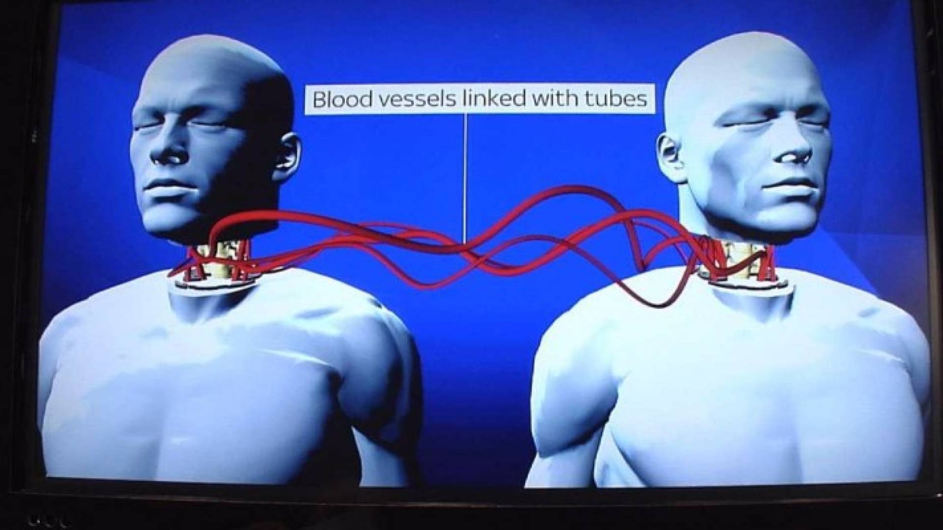 عملية زراعة رأس بشري