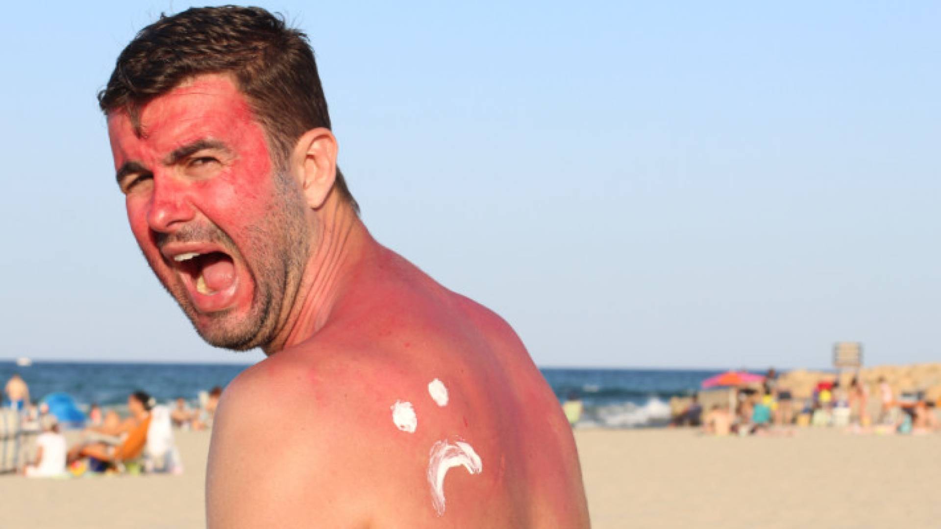 شخص مصاب بحروق الشمس