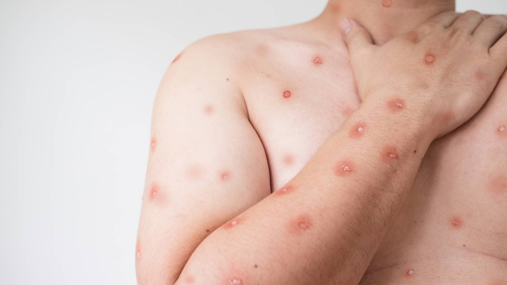 مرض جدري القرود