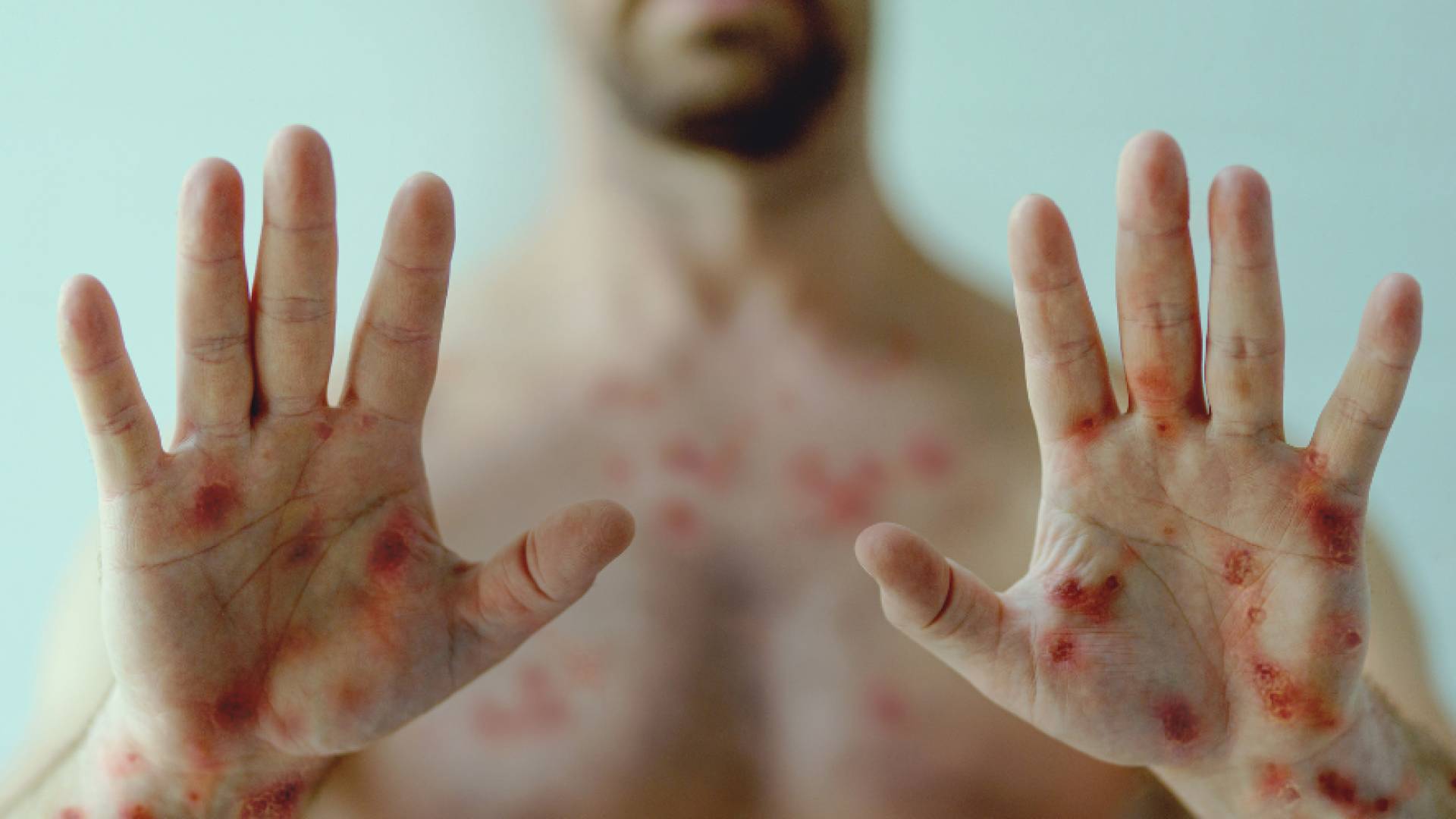 هل يشكل جدري القرود جائحة جديدة؟ "الصحة العالمية" توضح