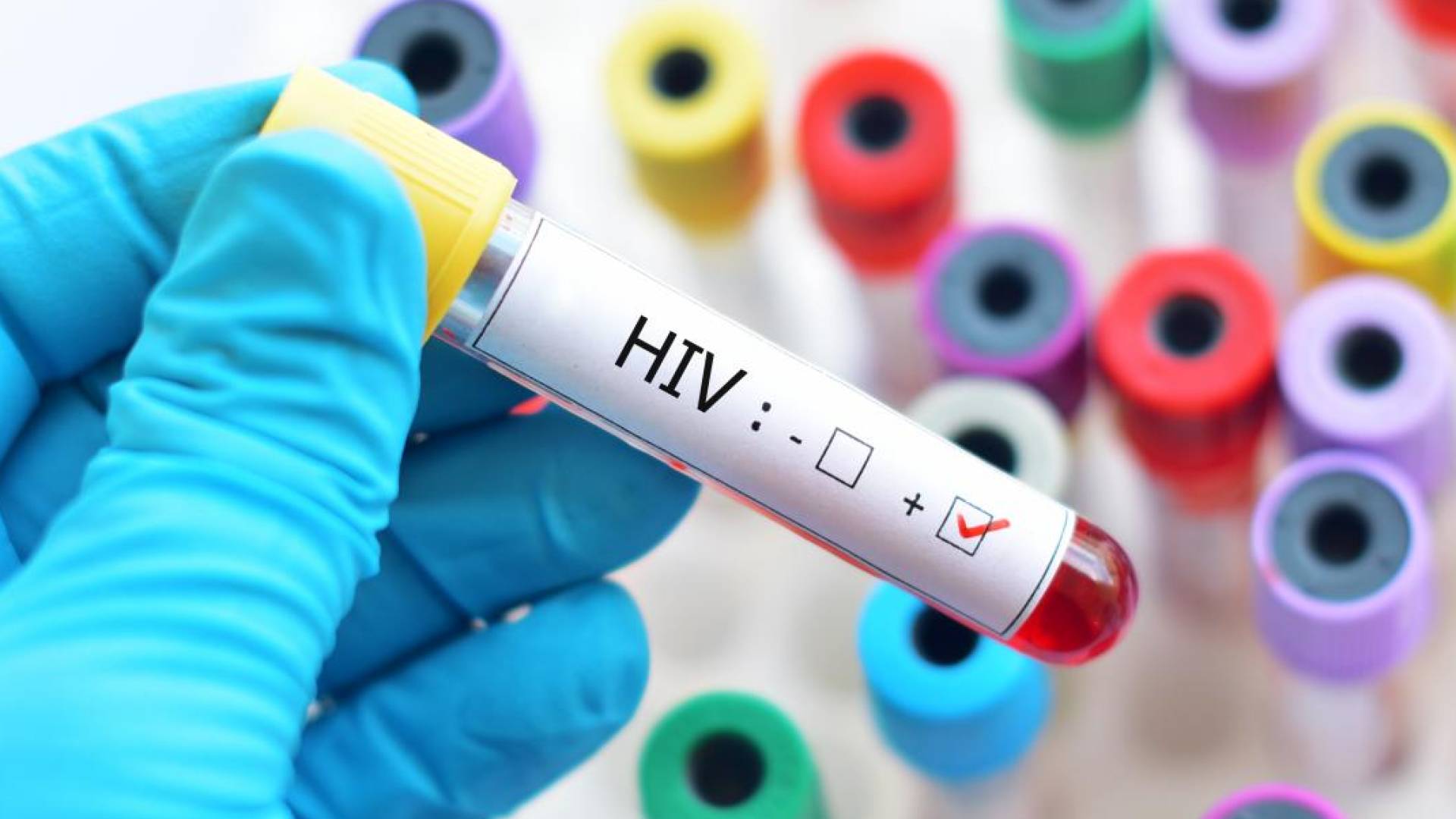 عينة لفحص فيروس نقص المناعة البشري