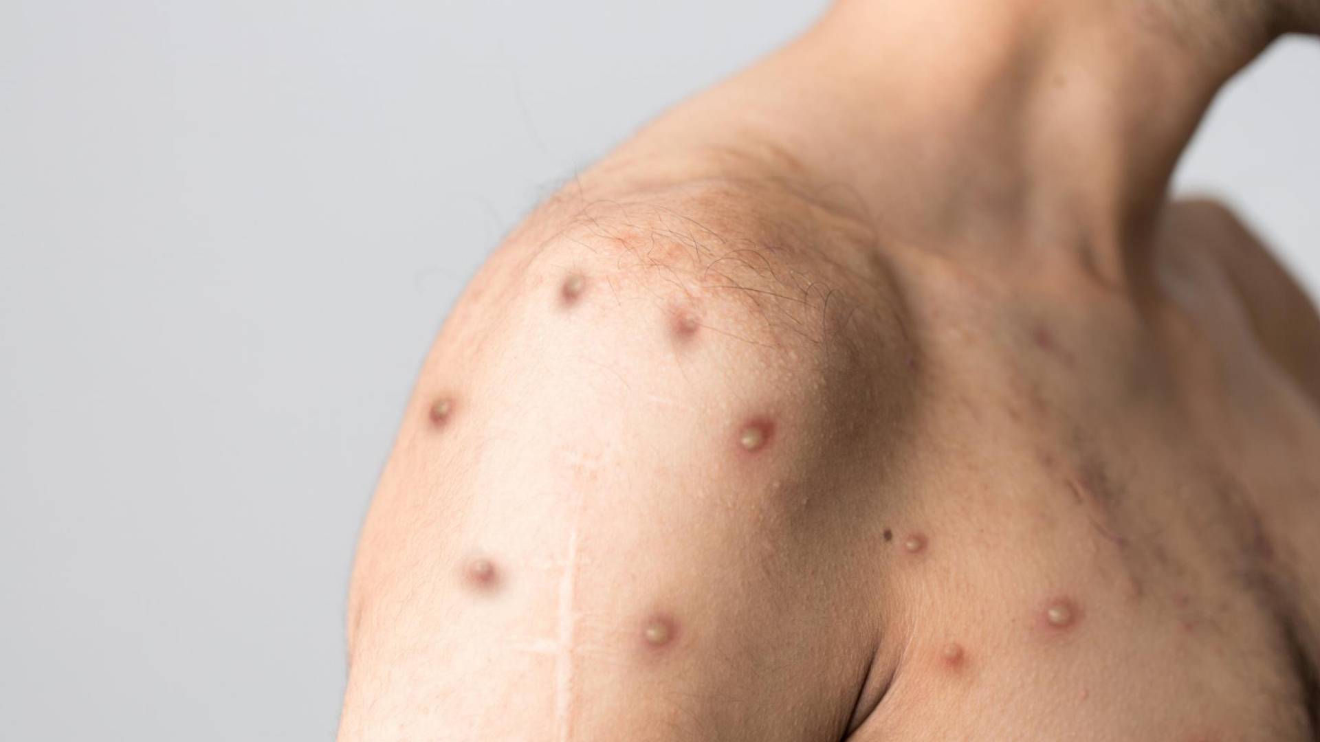 صورة تظهر رجل مصاب بجدري القرود