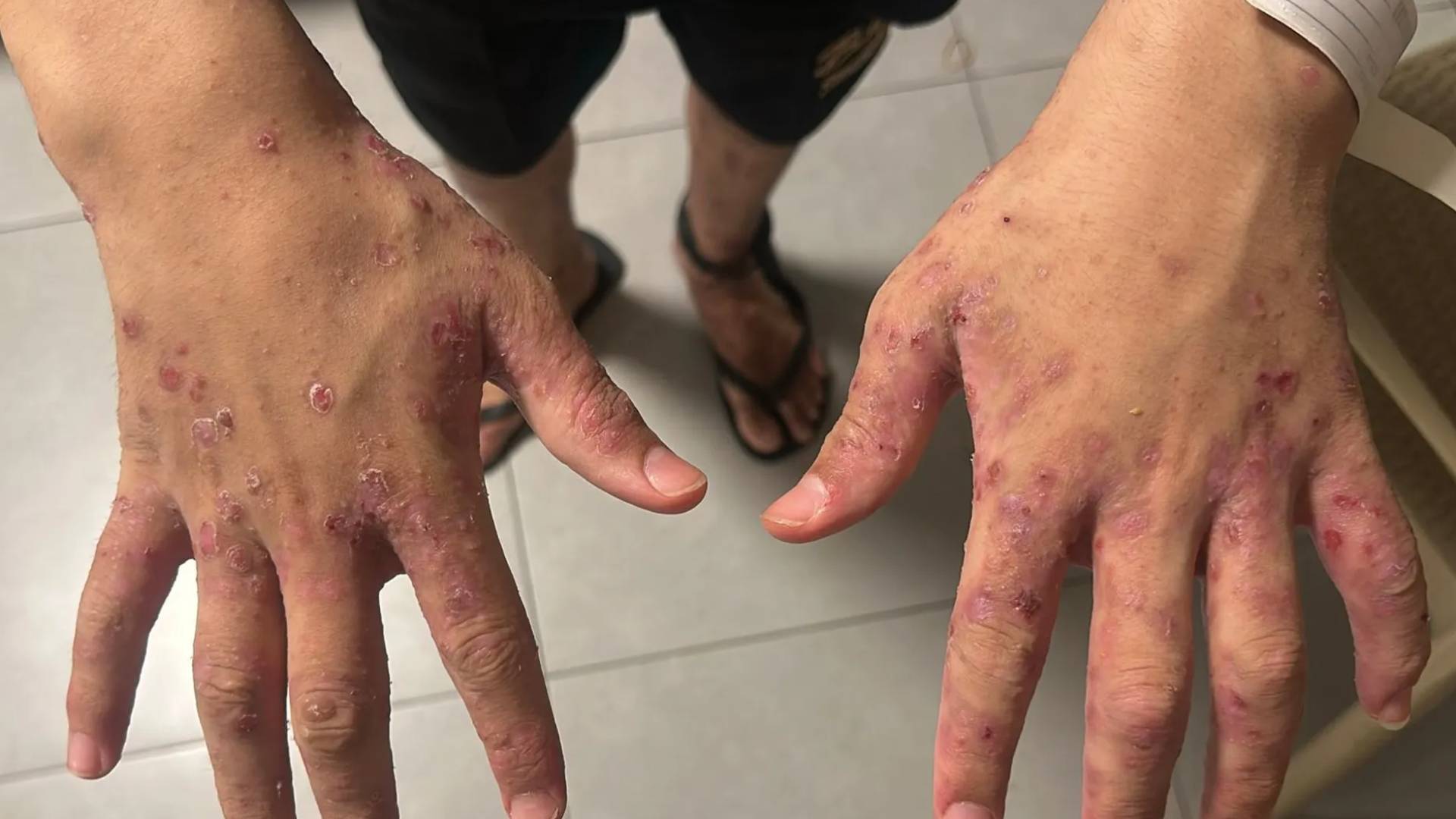 "شؤون الأسرى ونادي الأسير": الاحتلال يستخدم مرض الجرب كأسلوب لتعذيب الأسرى