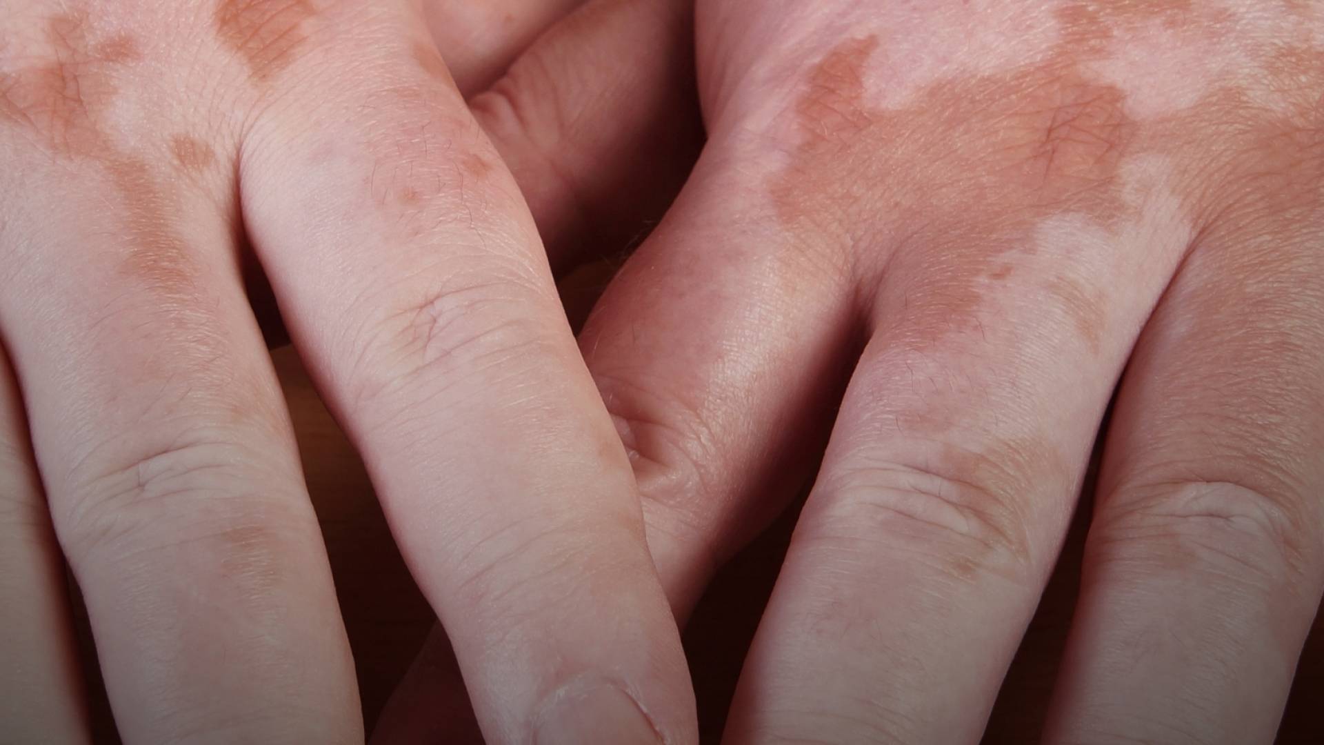 صورة لشخص مصاب بالبهاق