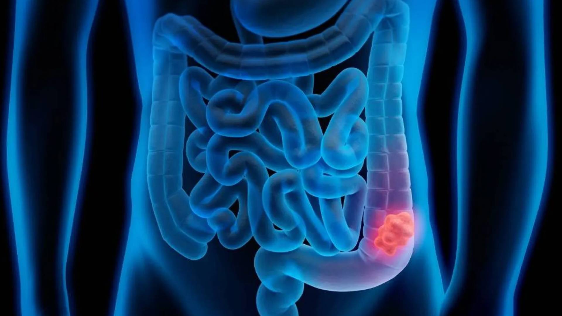 سرطان القولون