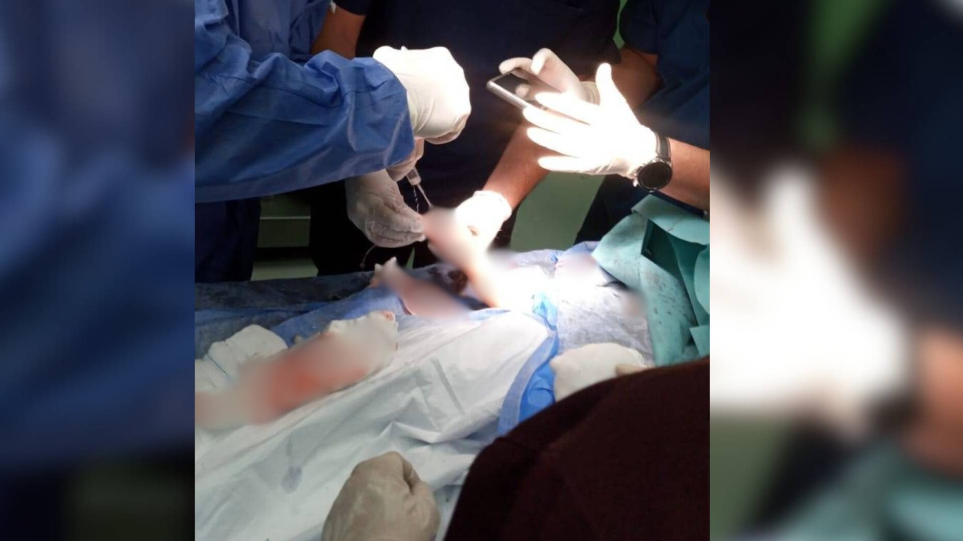 صورة تظهر إنقاذ طفل علقت يده داخل ماكينة فرم اللحوم في حادثة سابقة