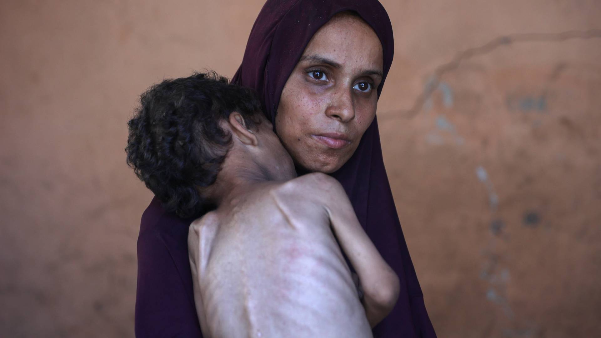 hمرأة وطفل في غزةيعانون من سوء التغذية