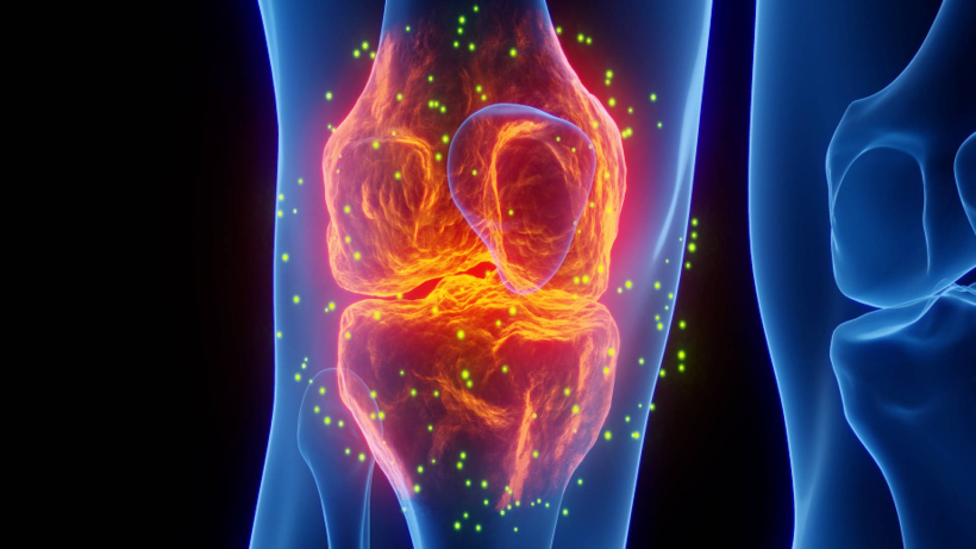 هشاشة العظام "تعبيرية"