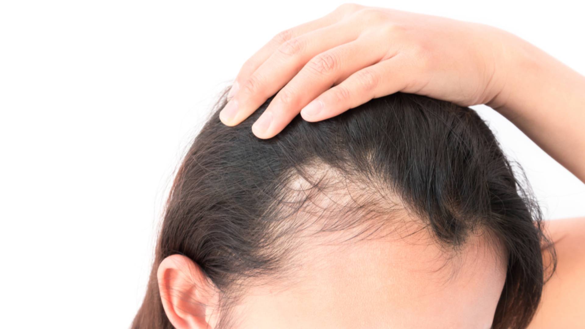 تساقط الشعر الوراثي