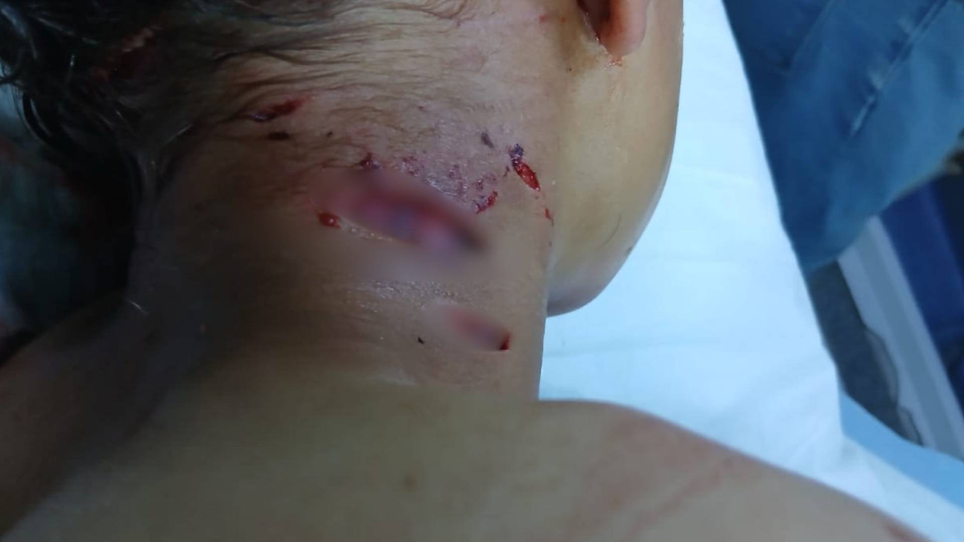 طفل يتعرض لهجوم كلاب ضالة